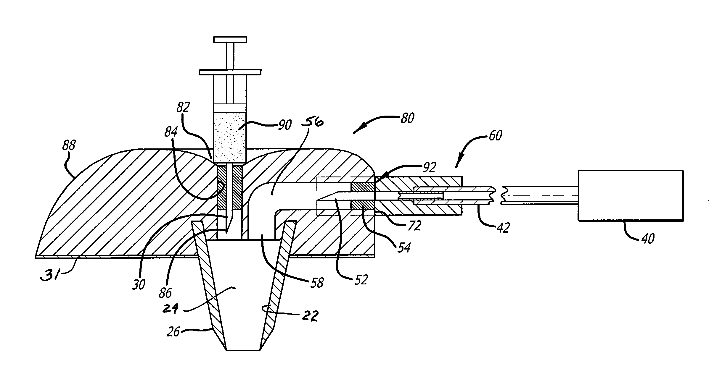 Injection port device adapted for use with insulin pump