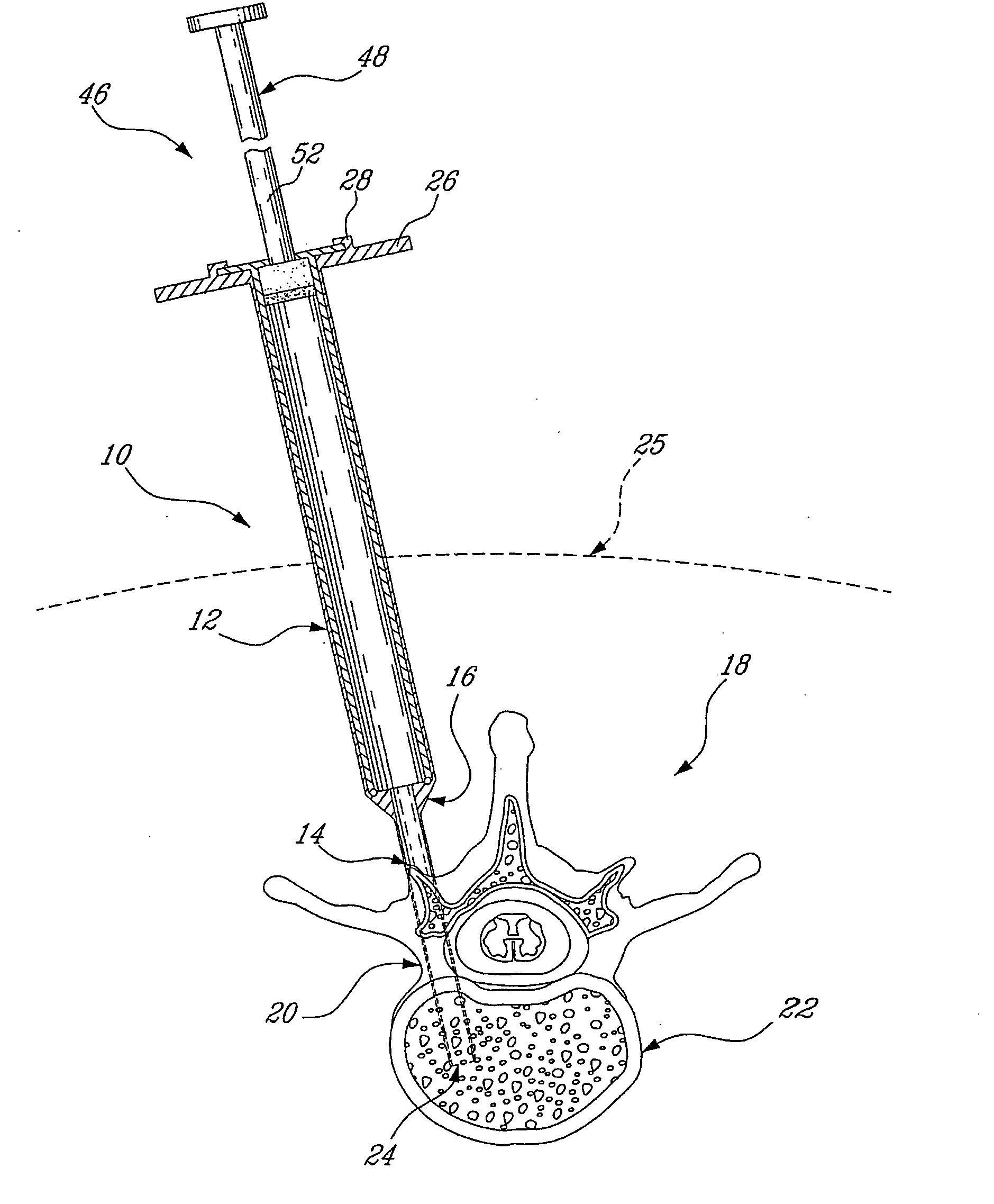 Device for injecting a viscous material into a hard tissue