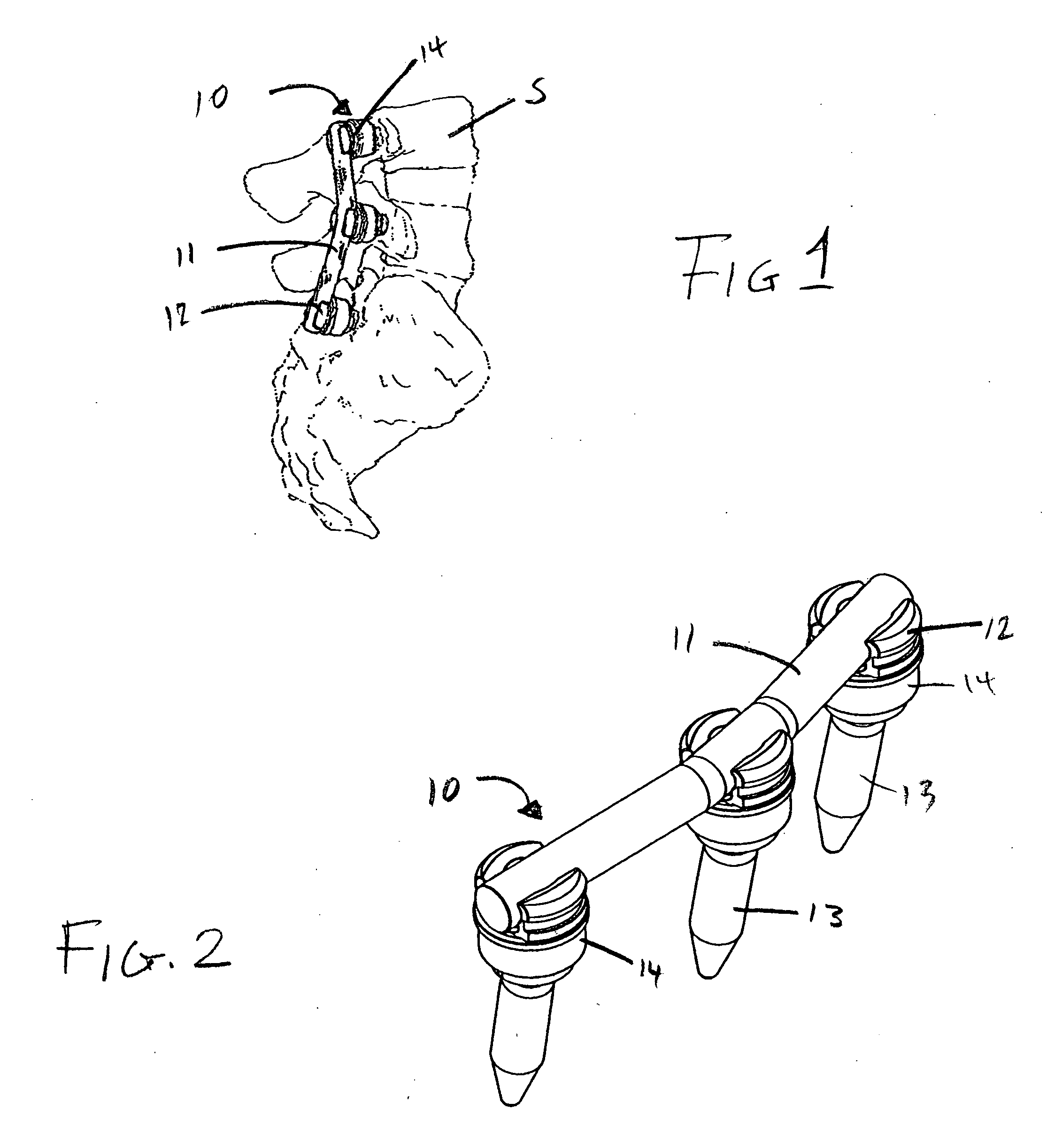 Bone fixation system with low profile fastener