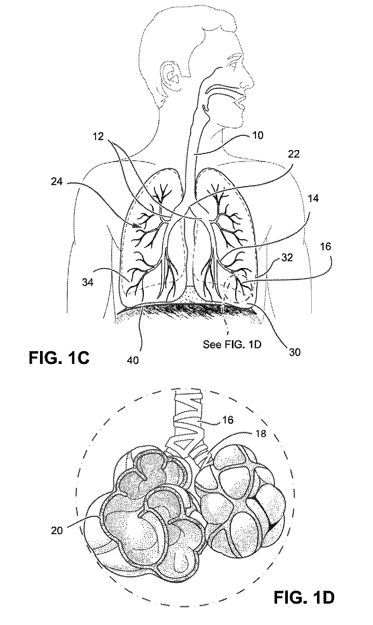 Methods and devices for the treatment of pulmonary disorders