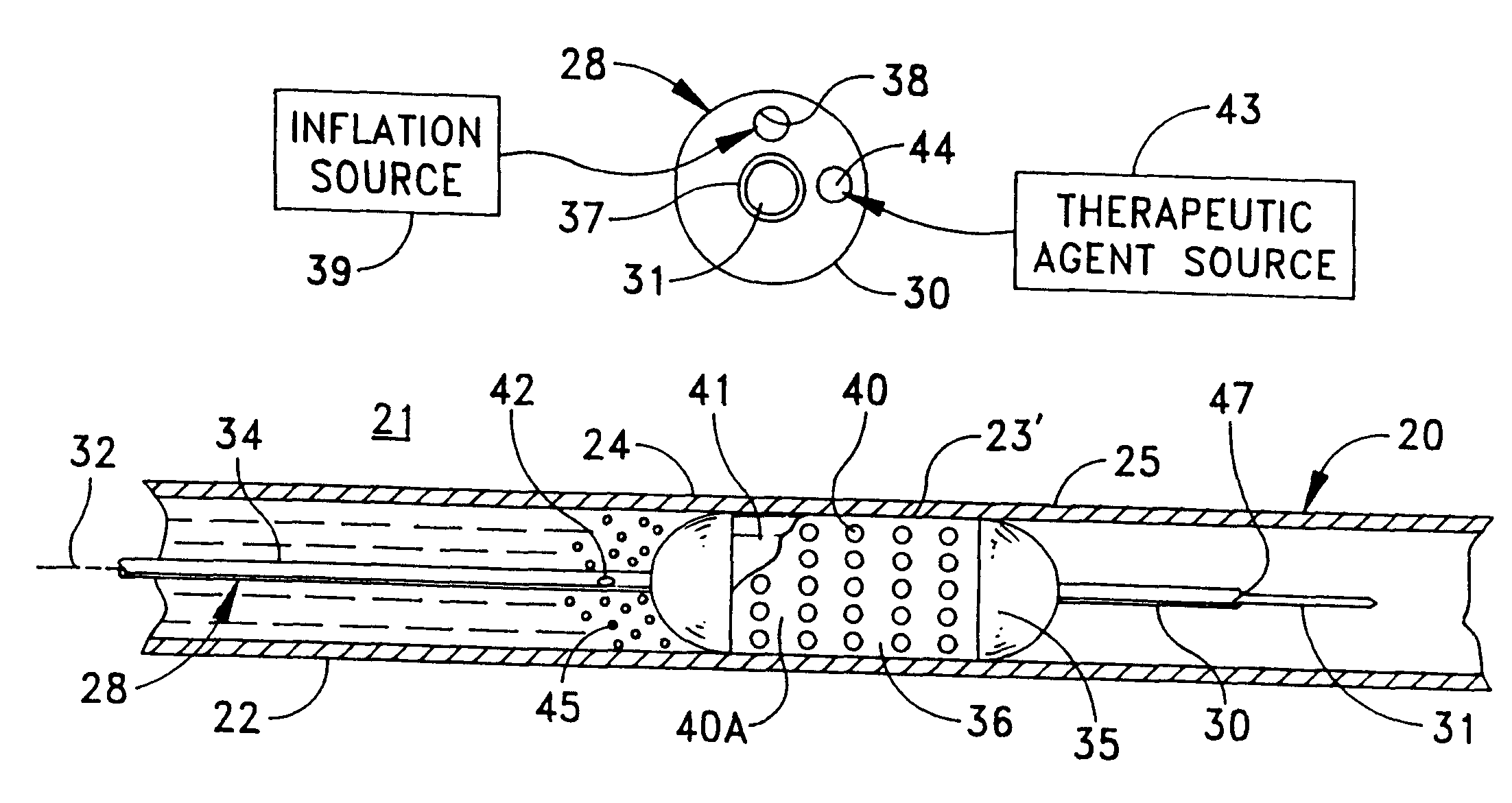 Replenishable stent and delivery system