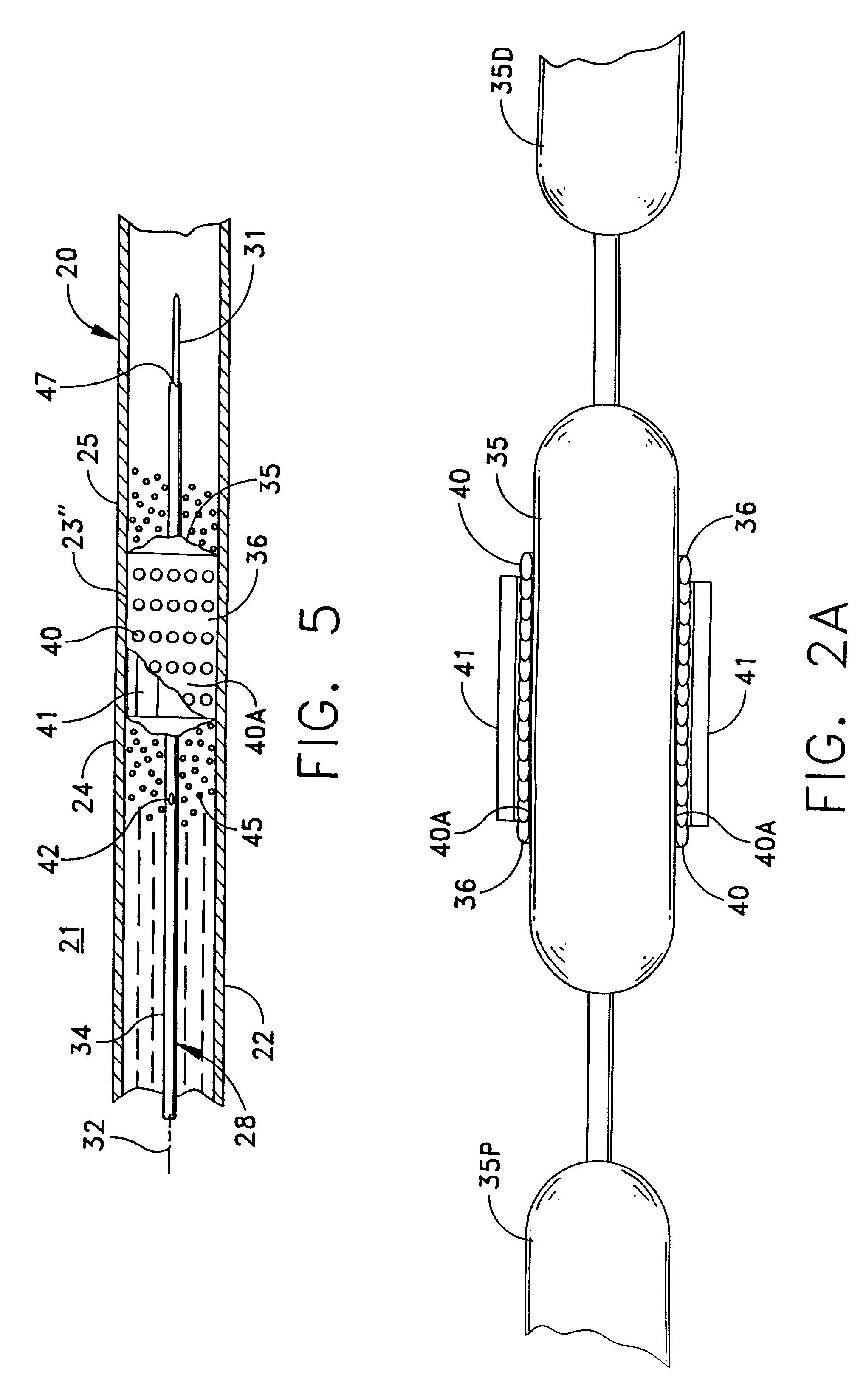 Replenishable stent and delivery system