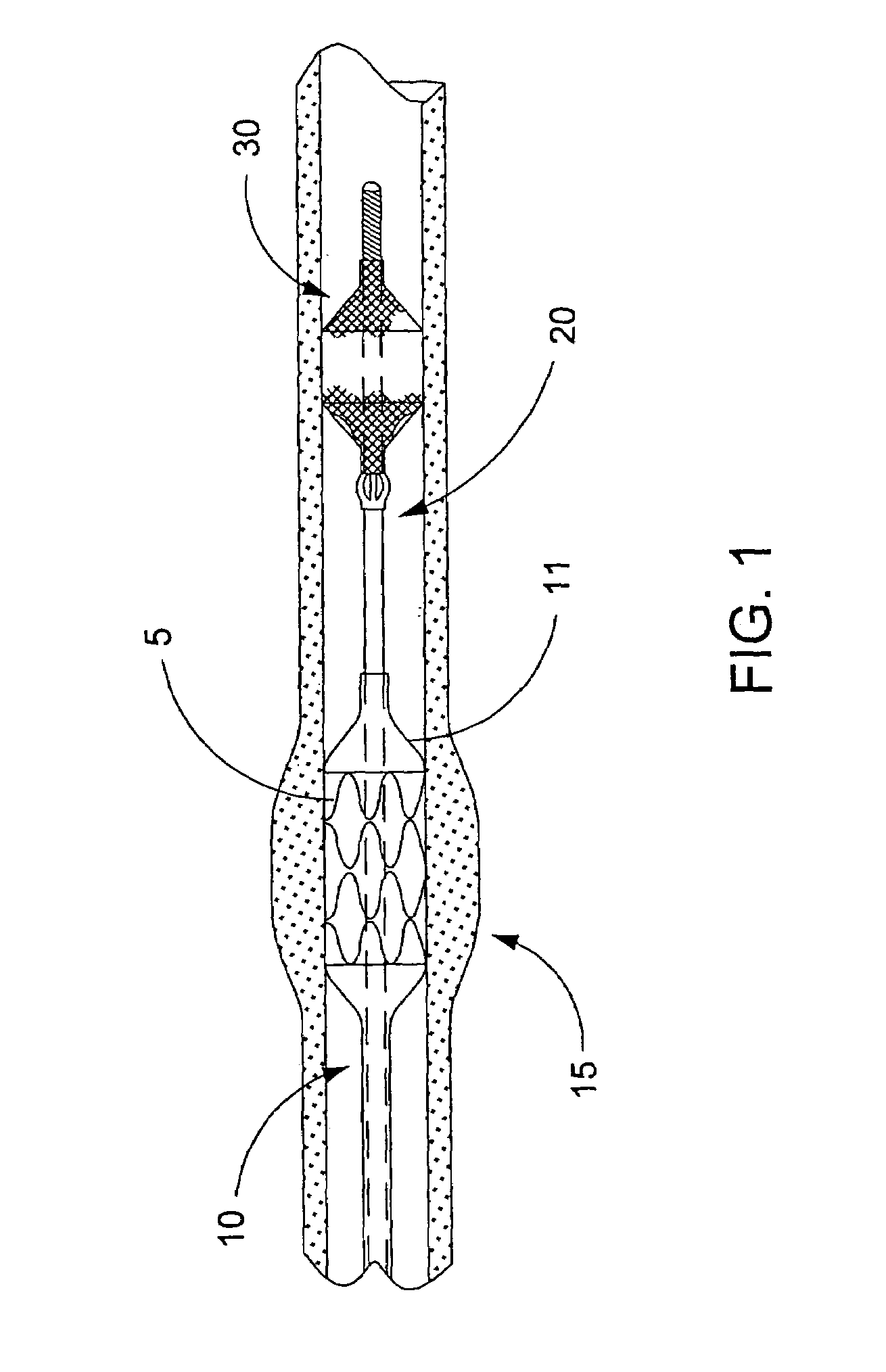 Temporary device for capturing embolic material