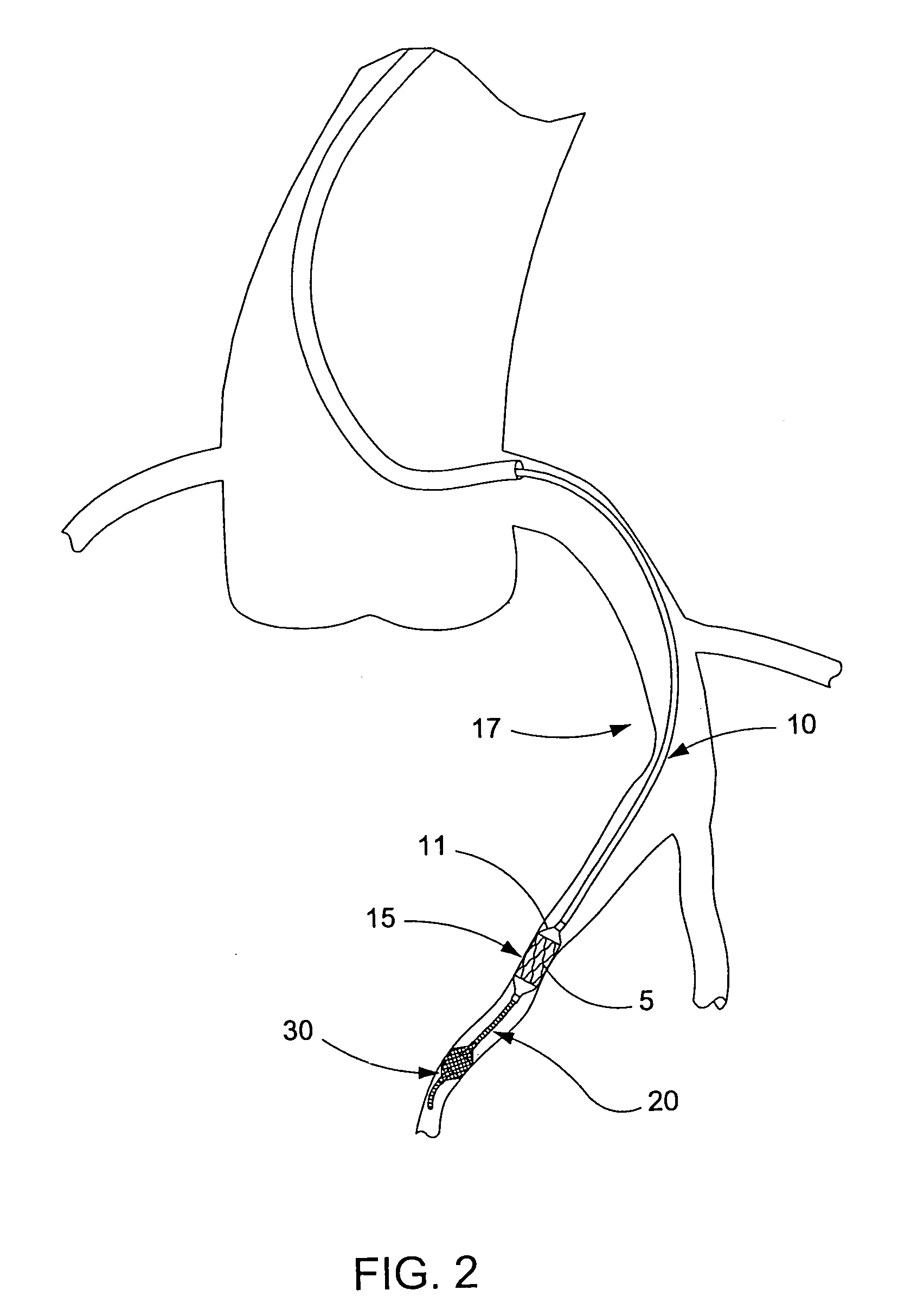 Temporary device for capturing embolic material