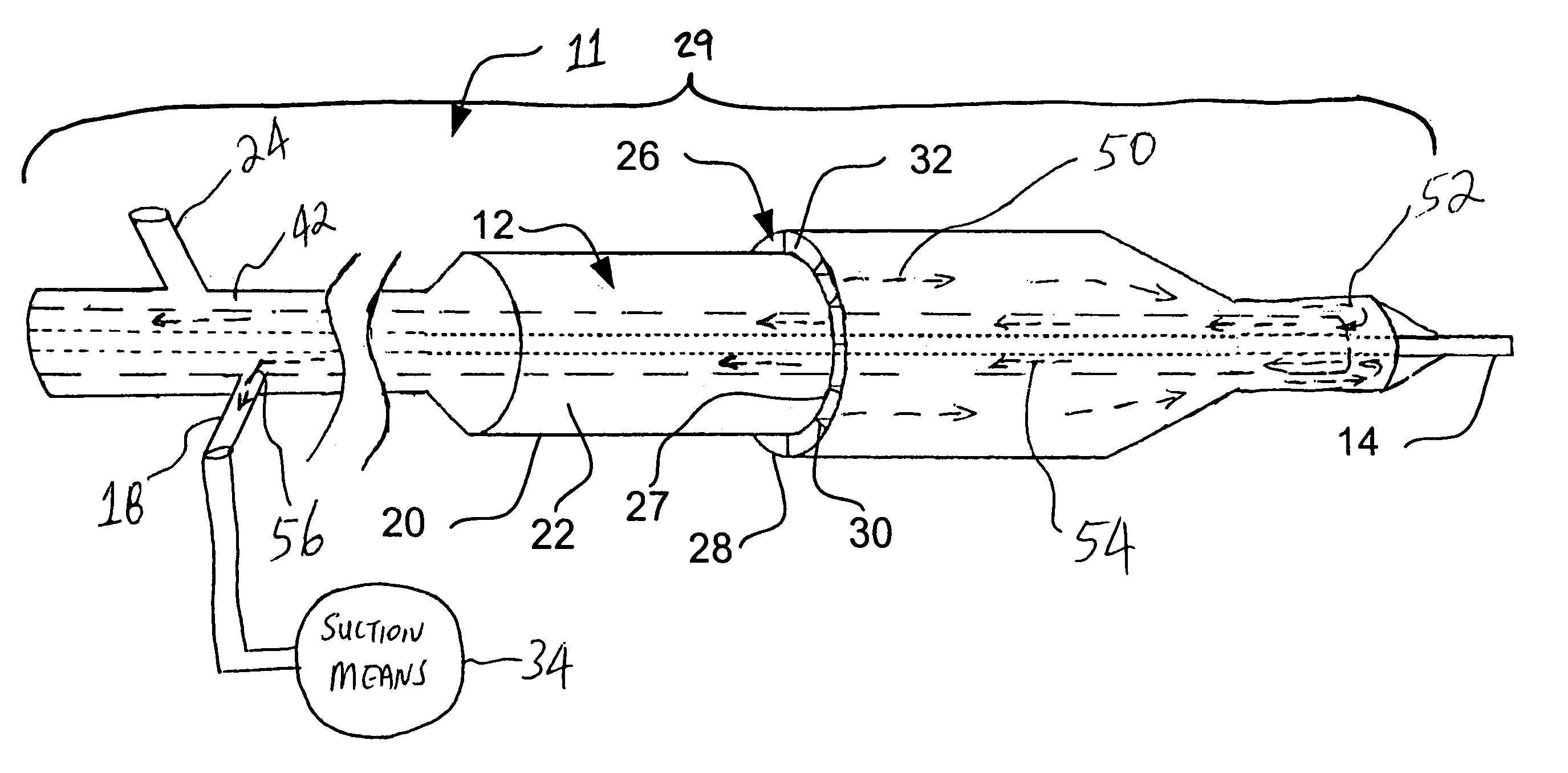 Aspirating balloon catheter for treating vulnerable plaque