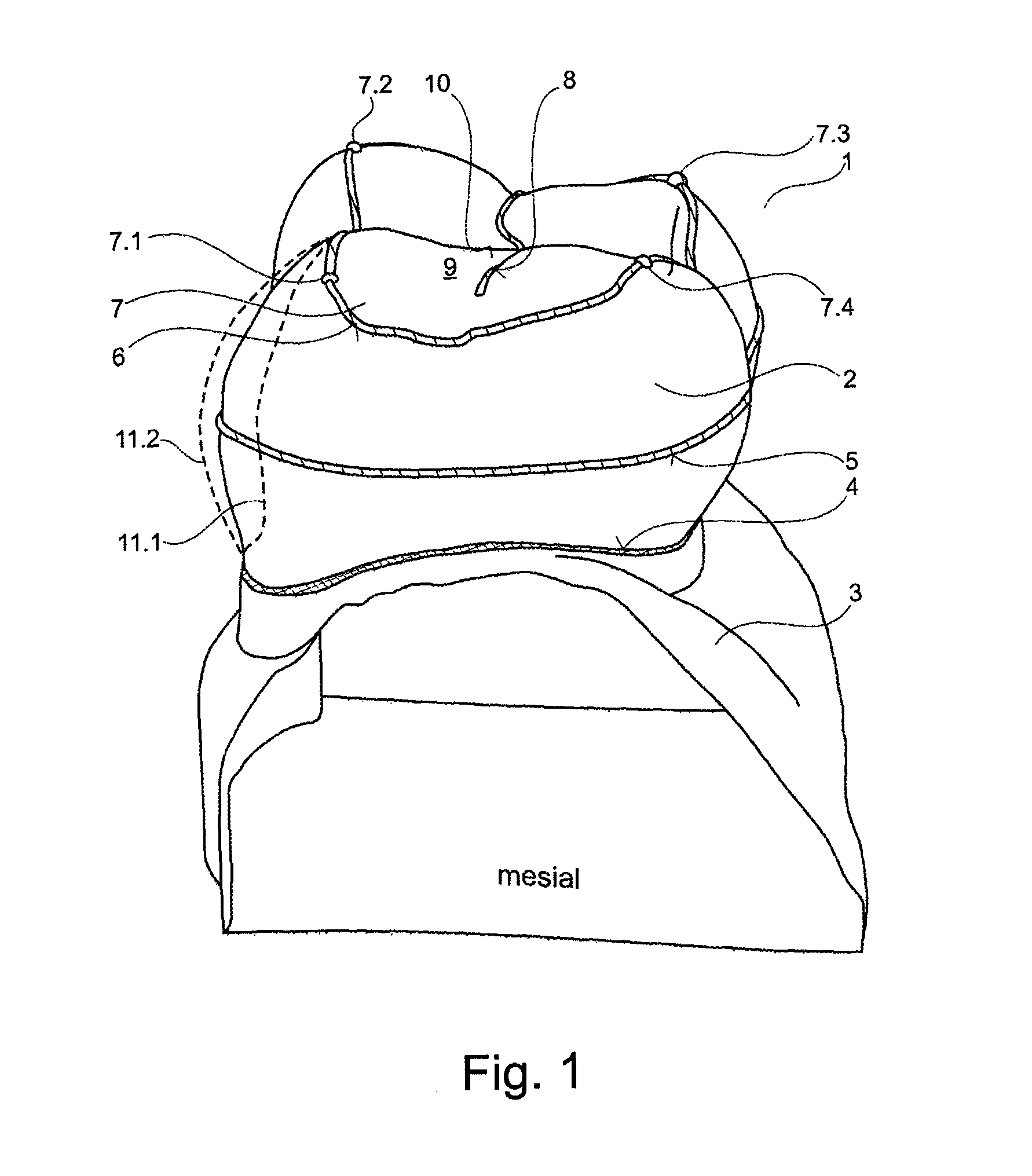 Device for selecting an area of a dental restoration body, which is depicted in a 3D representation, and method therefor
