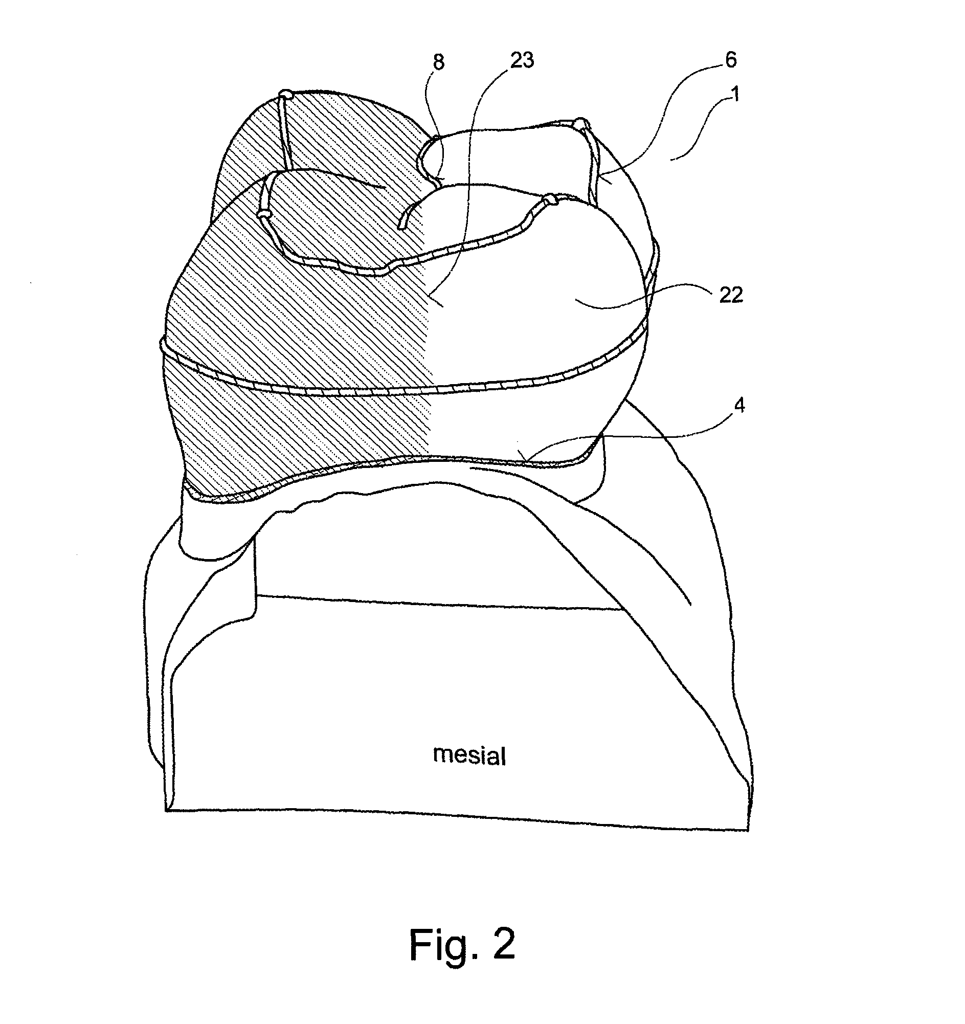 Device for selecting an area of a dental restoration body, which is depicted in a 3D representation, and method therefor