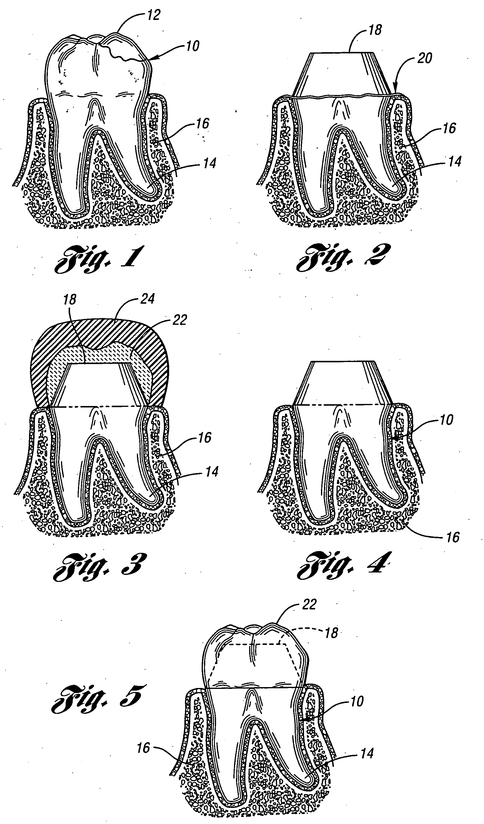 Method for creating a temporary dental crown