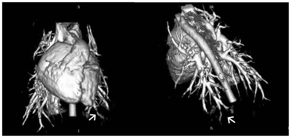 Pulmonary arterial hypertension non-human primate model and construction method thereof