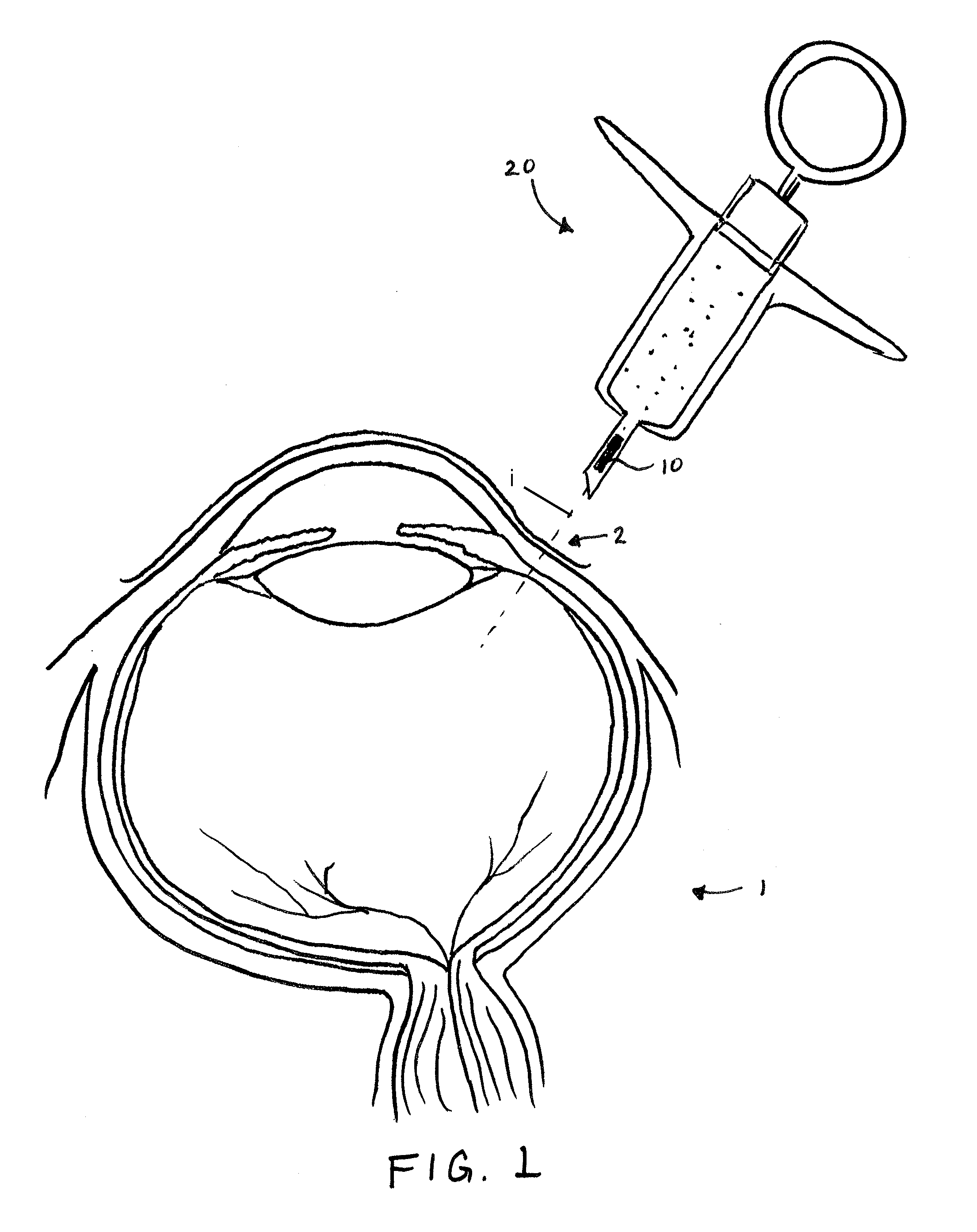 Methods and devices for implantation of intraocular pressure sensors