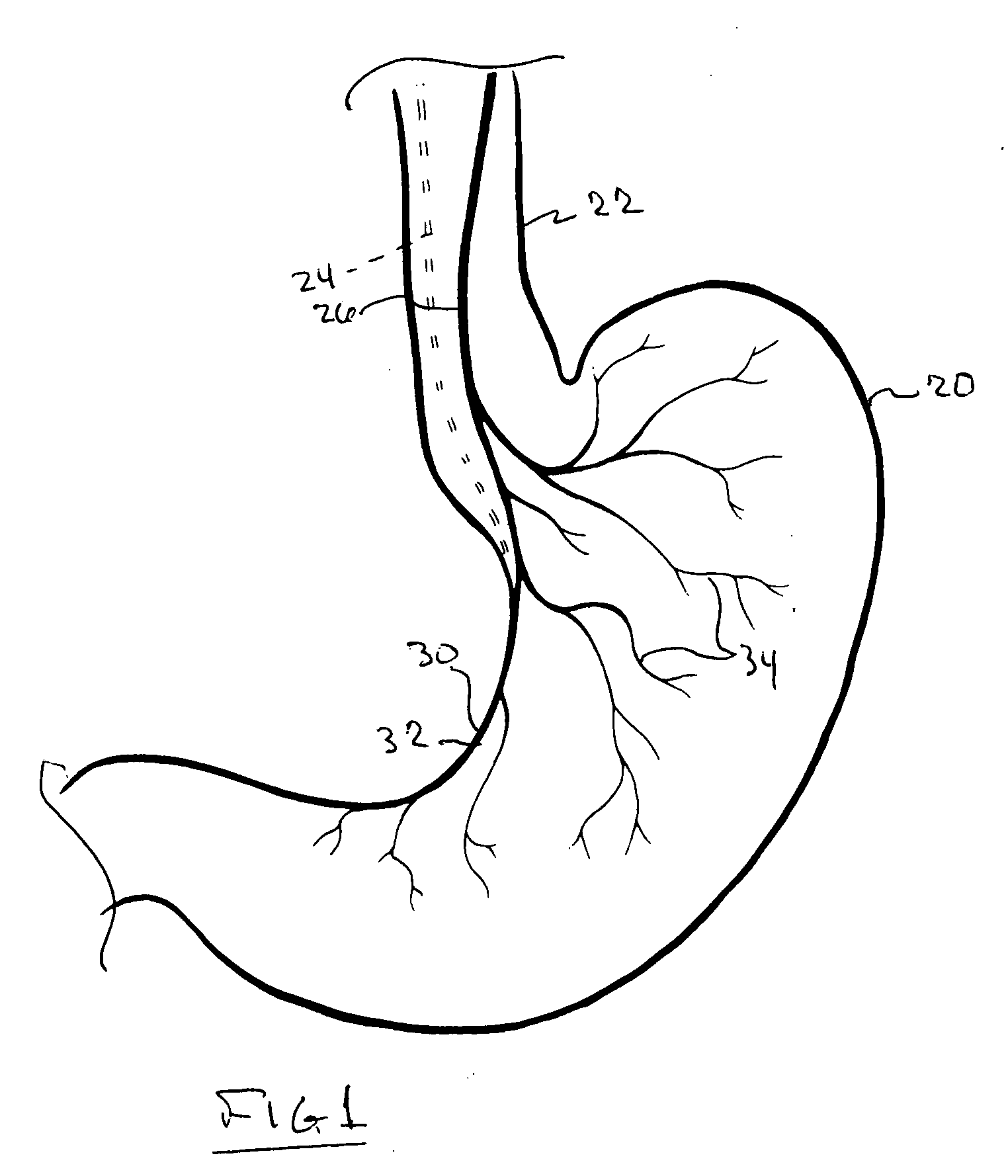 Vagal nerve bulking arrangement