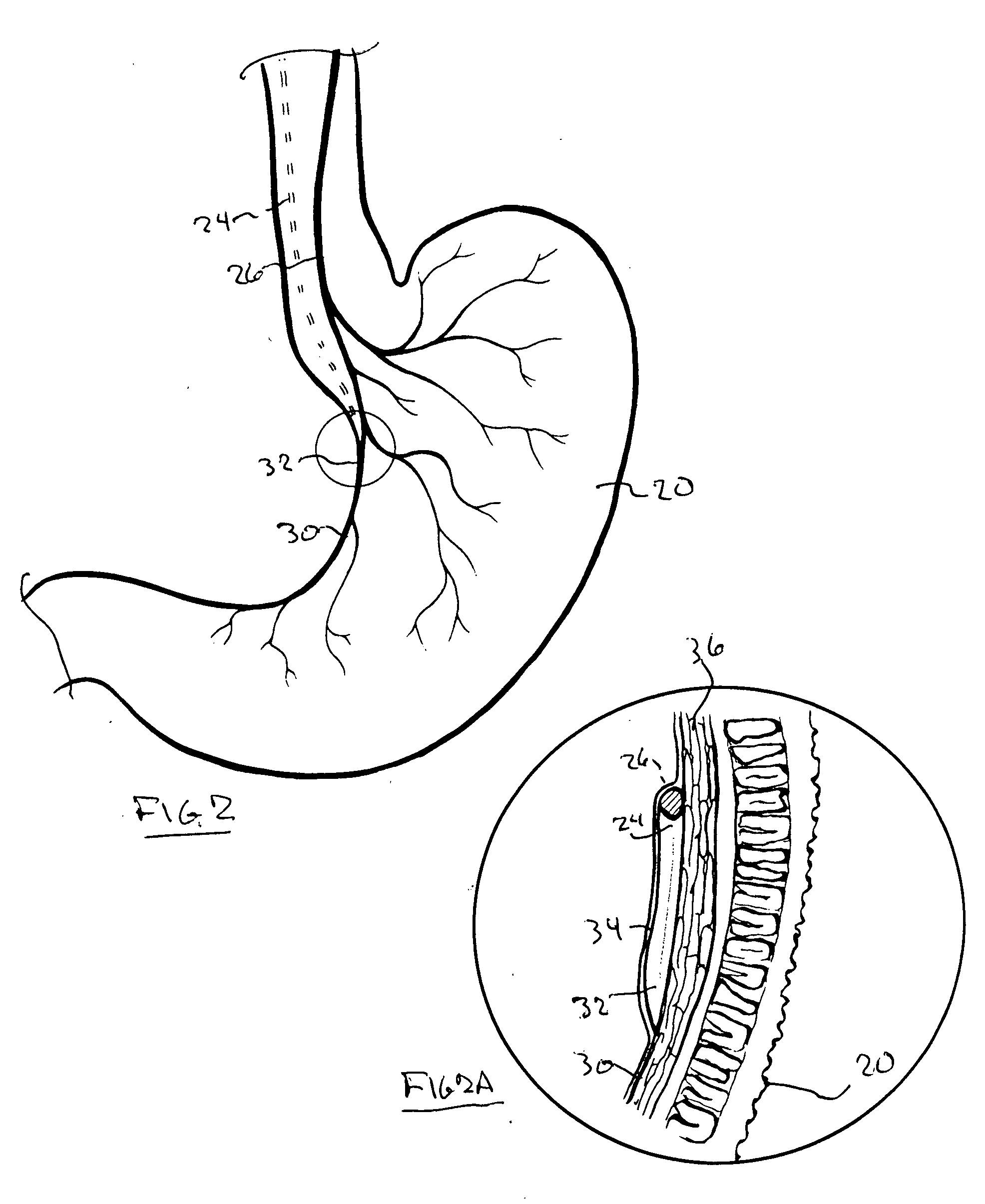 Vagal nerve bulking arrangement