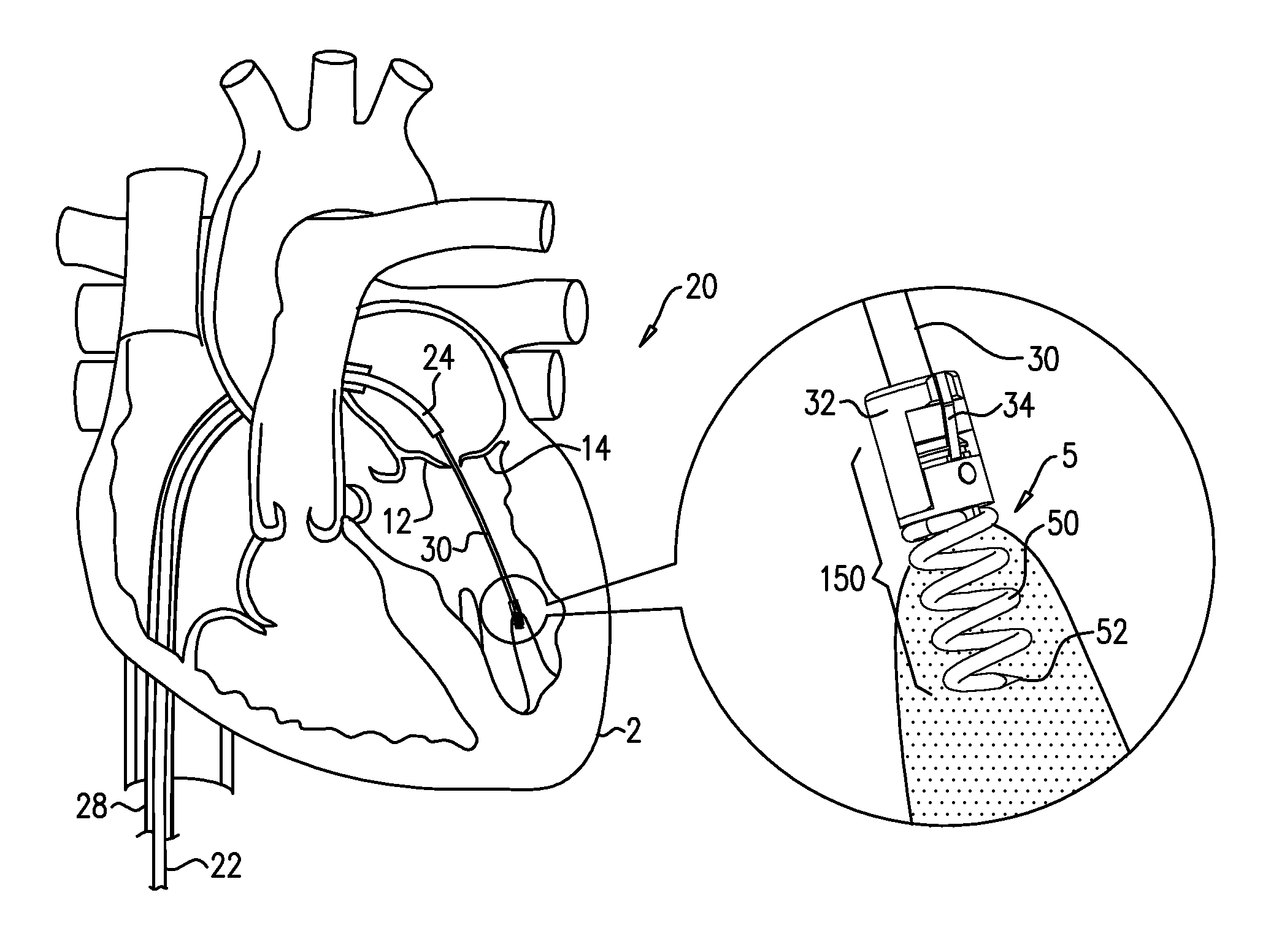 Apparatus and method for guide-wire based advancement of a rotation assembly