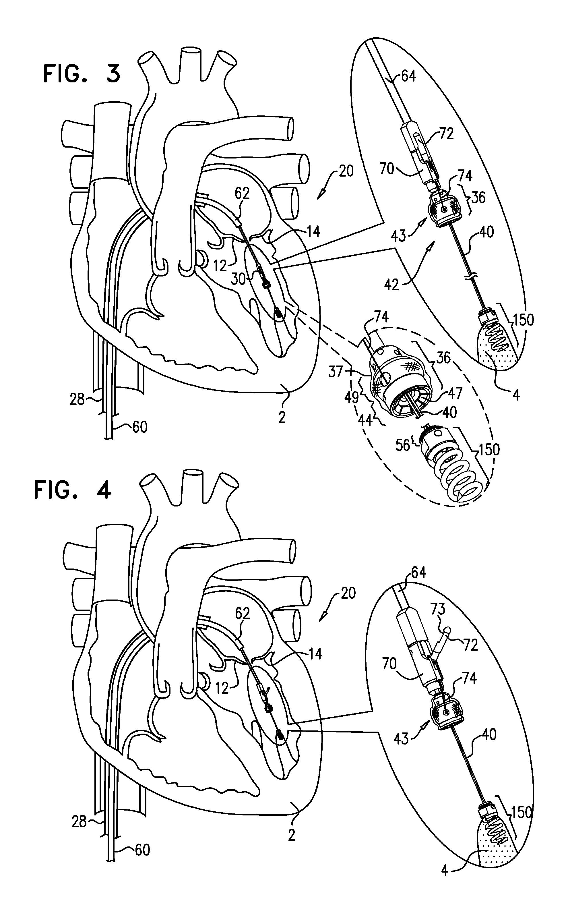 Apparatus and method for guide-wire based advancement of a rotation assembly