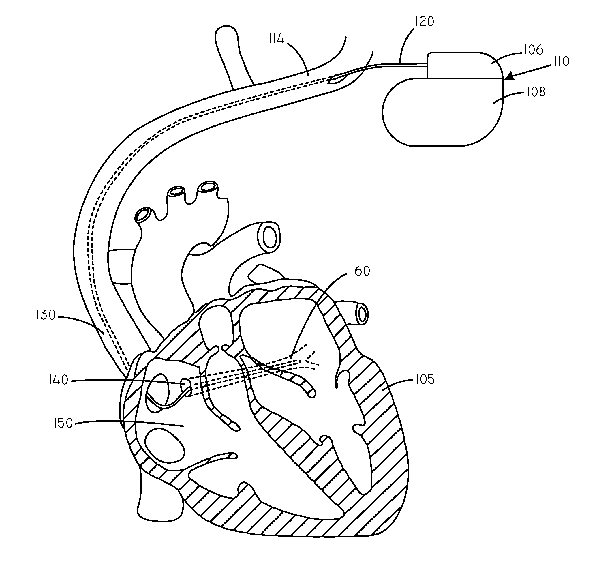 Temperature Based Systems and Methods for Tachycardia Discrimination and Therapy