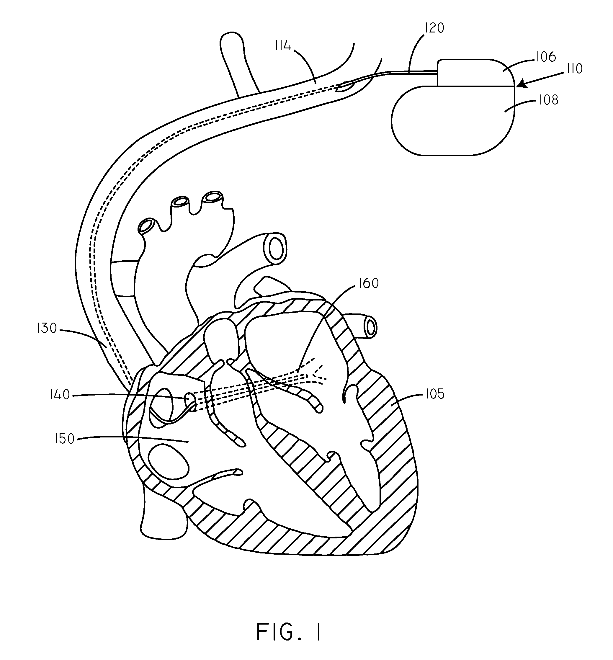 Temperature Based Systems and Methods for Tachycardia Discrimination and Therapy