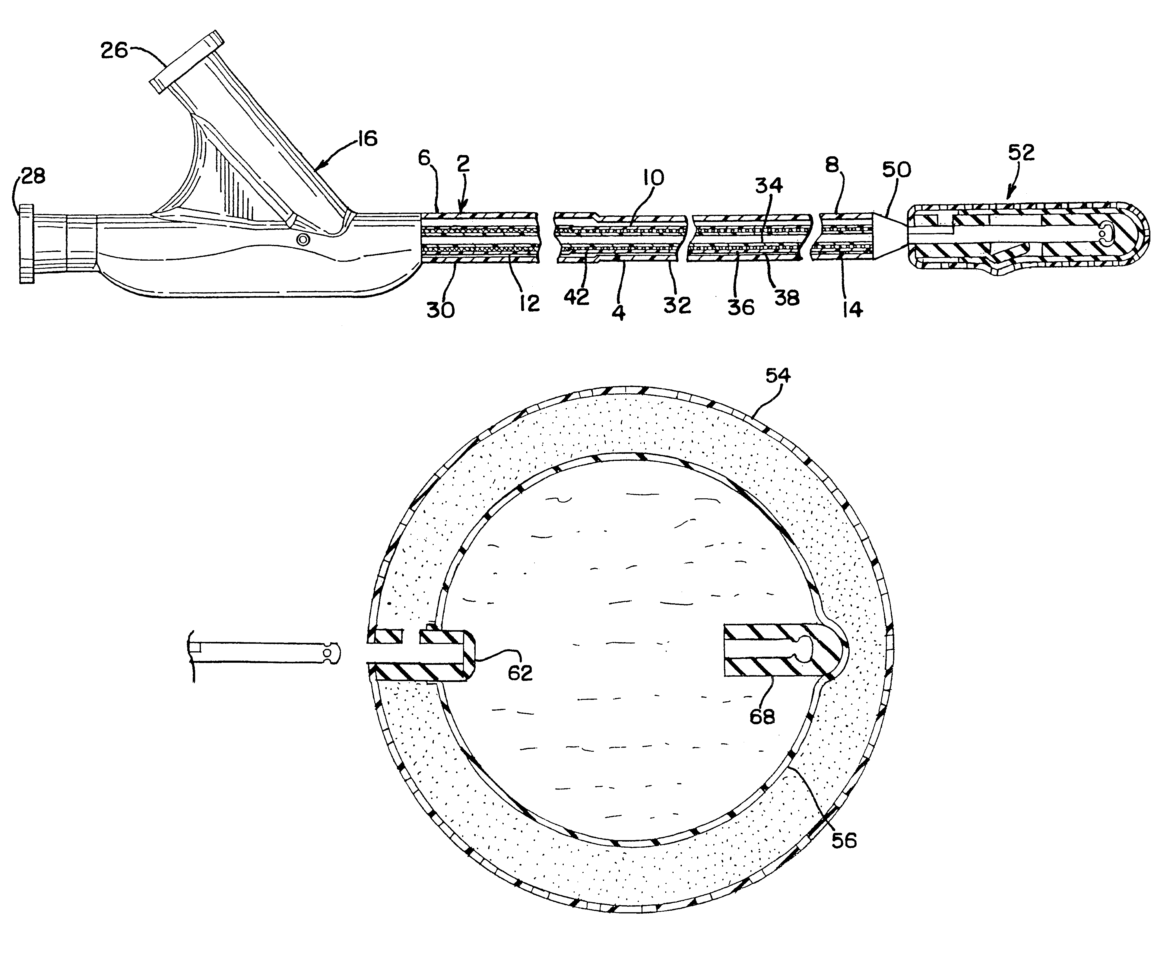 Detachable balloon embolization device and method
