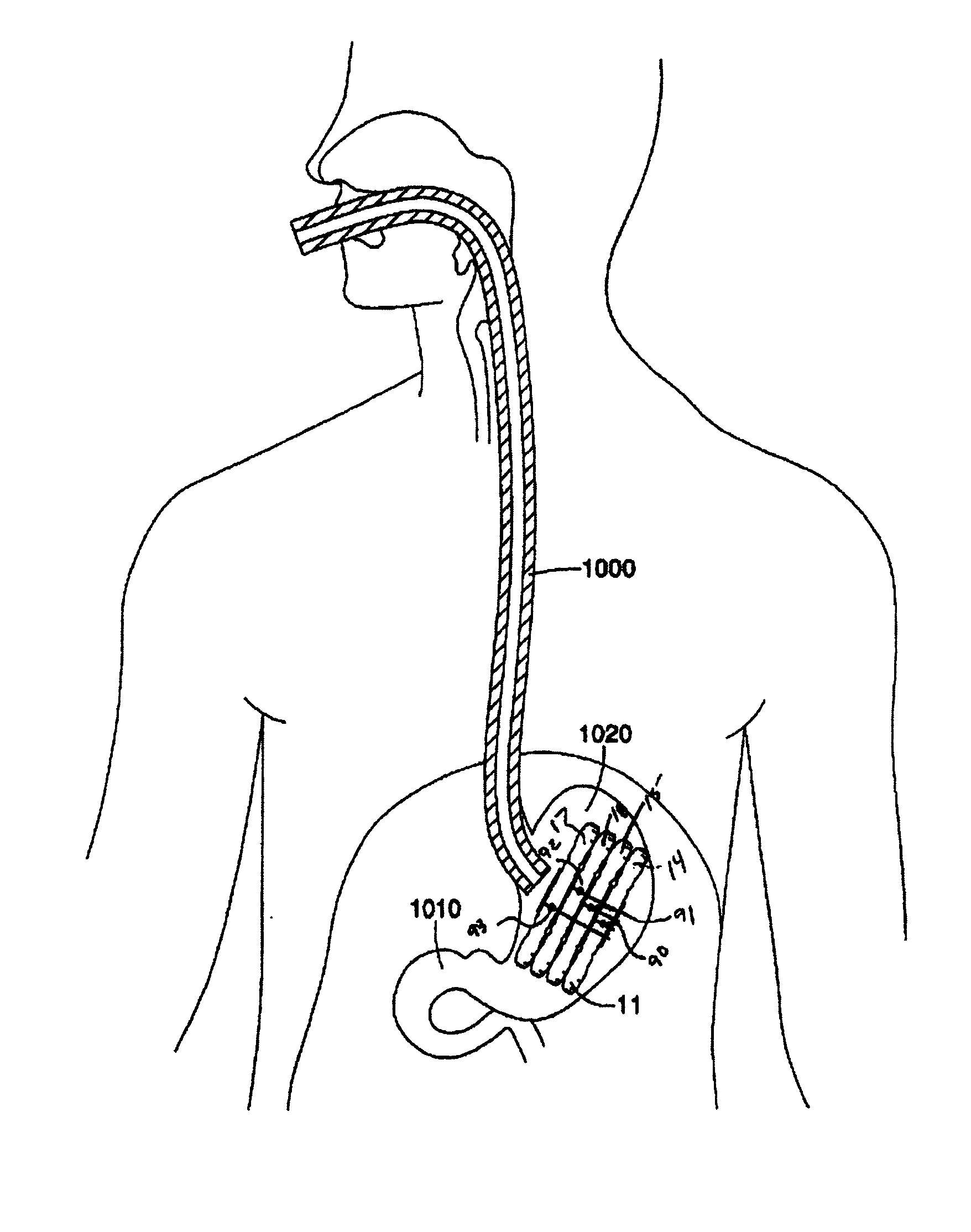 Method of delivering an intragastric device for treating obesity
