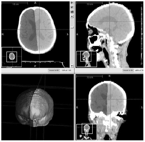 A Segmentation Method of Left and Right Hemibrain