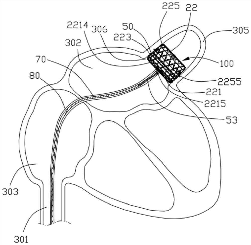 Ablation plugging device