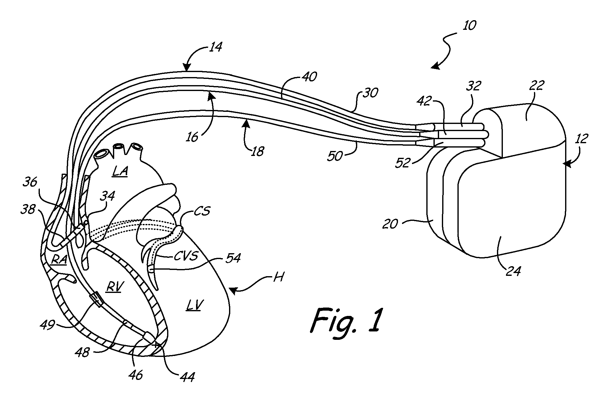 Implantable medical device with electromechanical delay measurement for lead position and ventricular