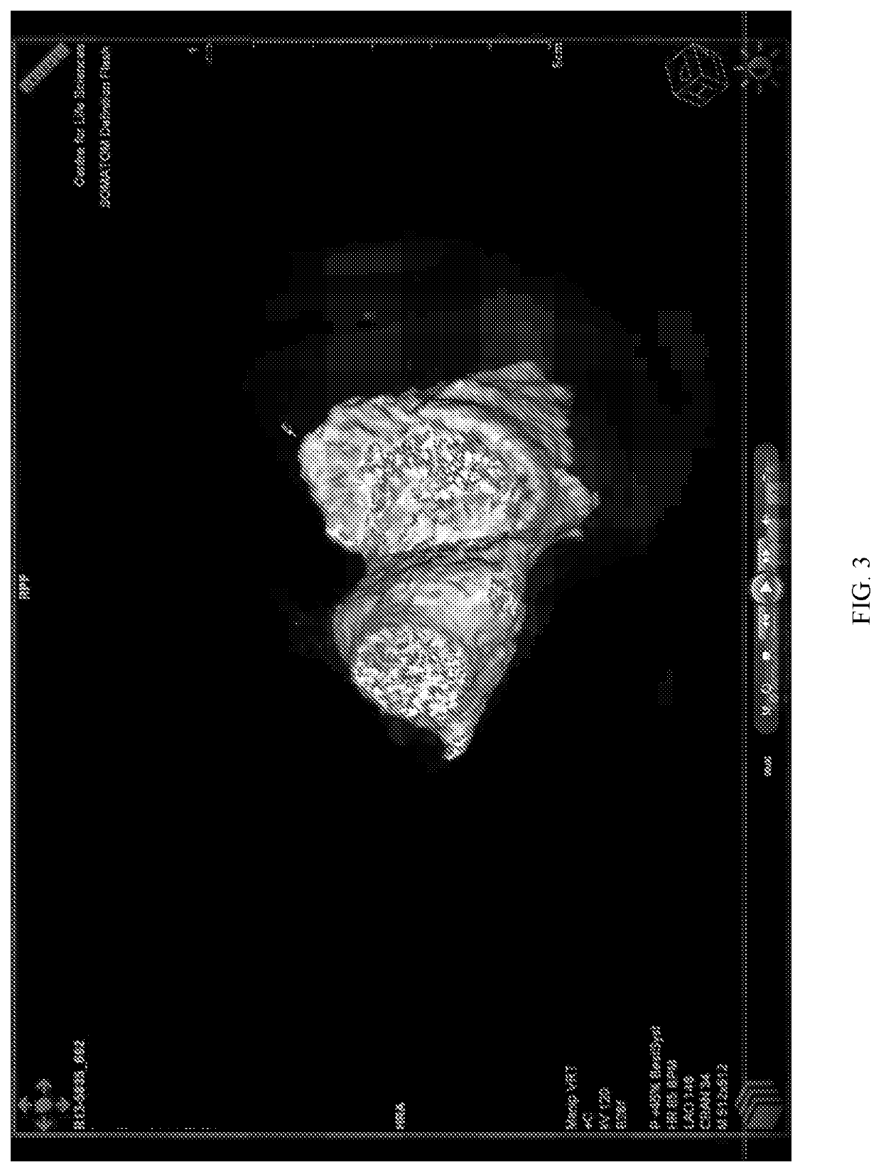 Naturally designed mitral prosthesis