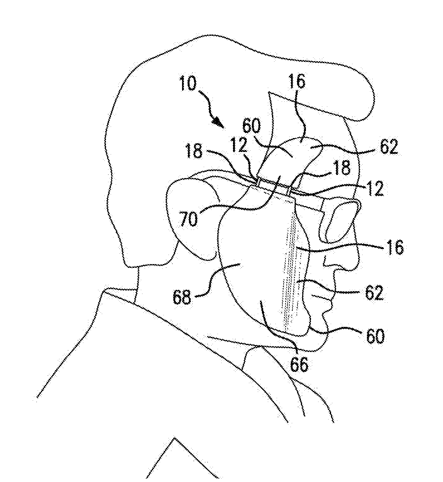 Protective skin shields system