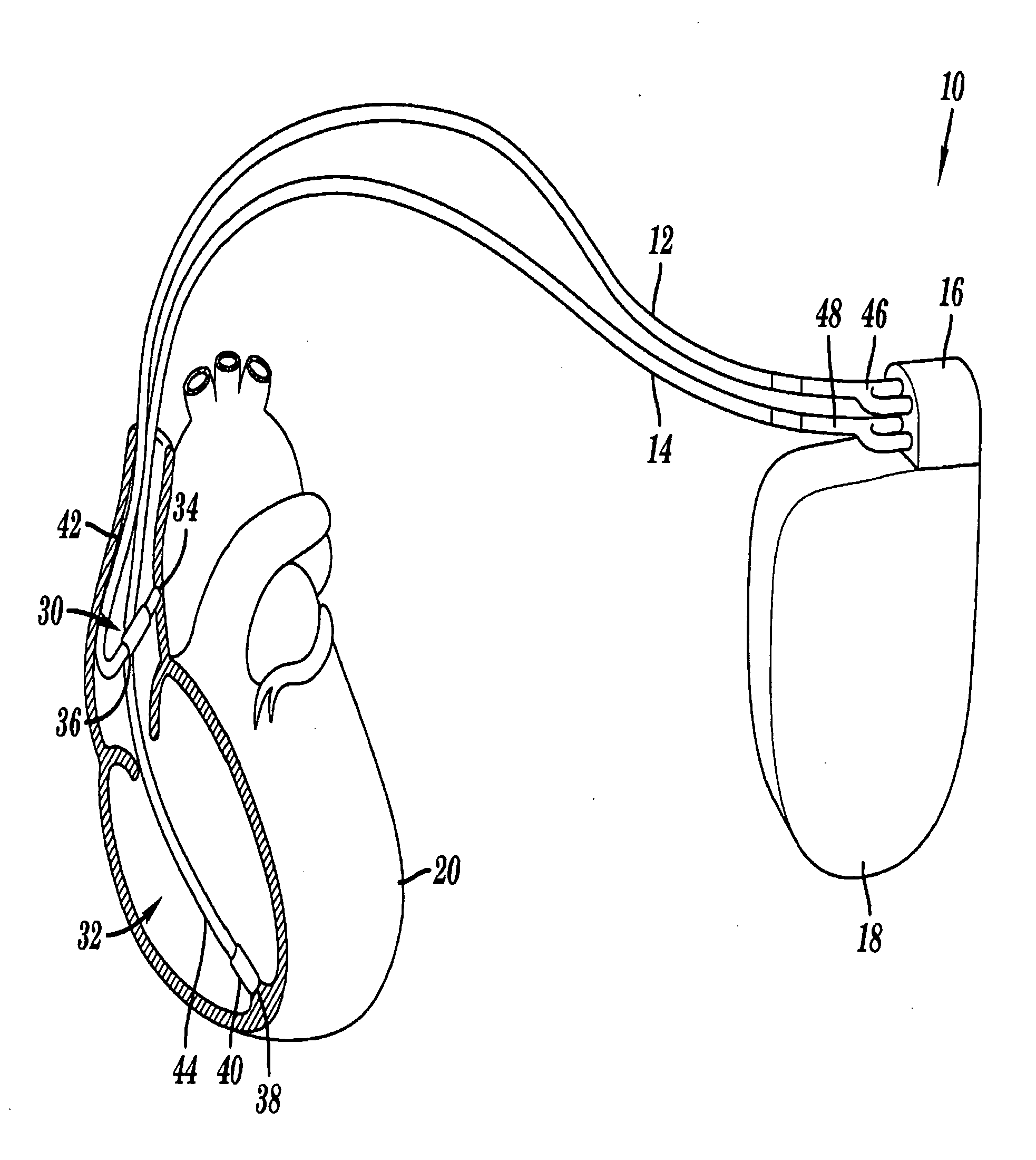 Pacemaker with neurocardiogenic syncope detection and therapy utilizing minute ventilation input