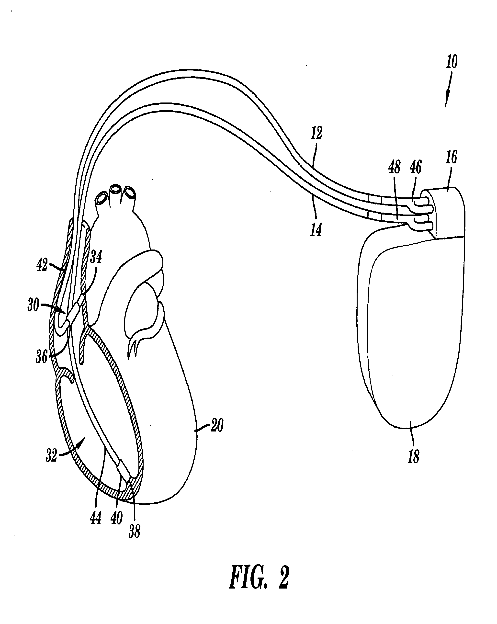 Pacemaker with neurocardiogenic syncope detection and therapy utilizing minute ventilation input