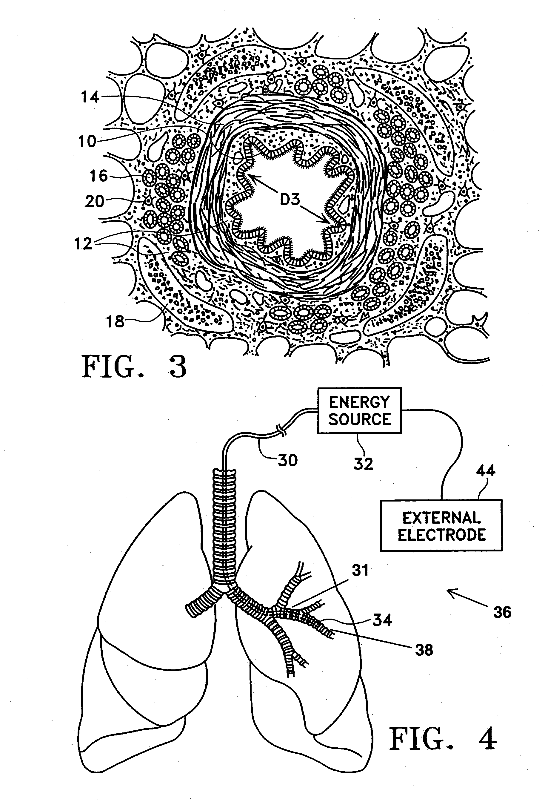 Method for treating an asthma attack