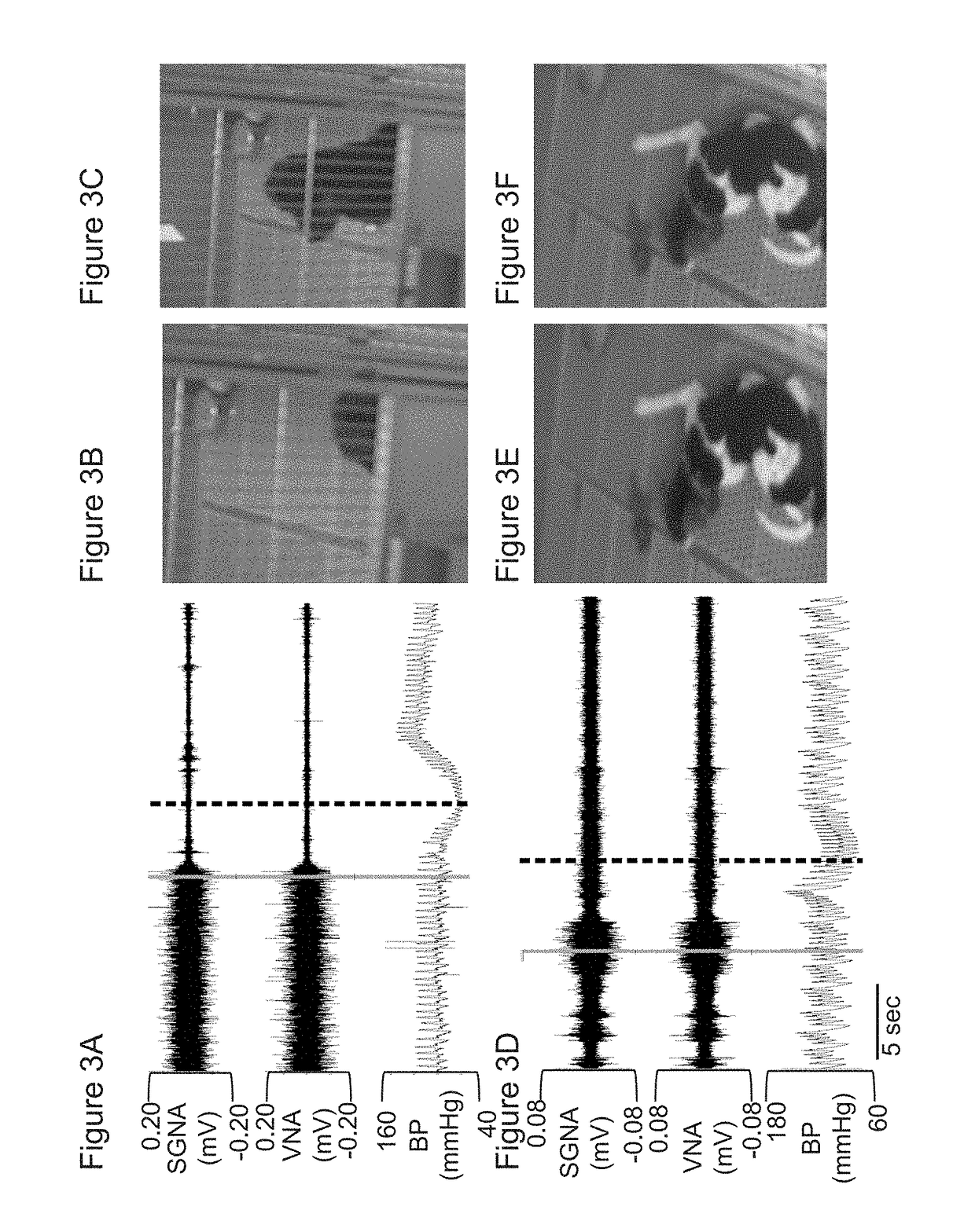 Beta 2 adrenoceptor antagonists for treating orthostatic hypotension