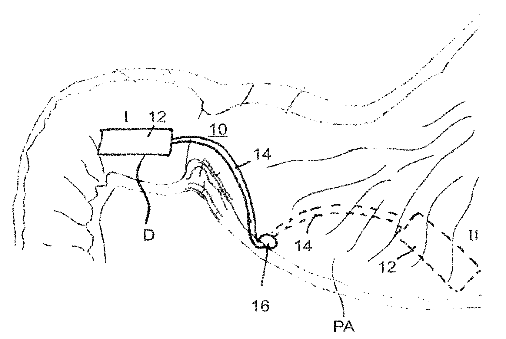 Devices and methods for altering eating behavior