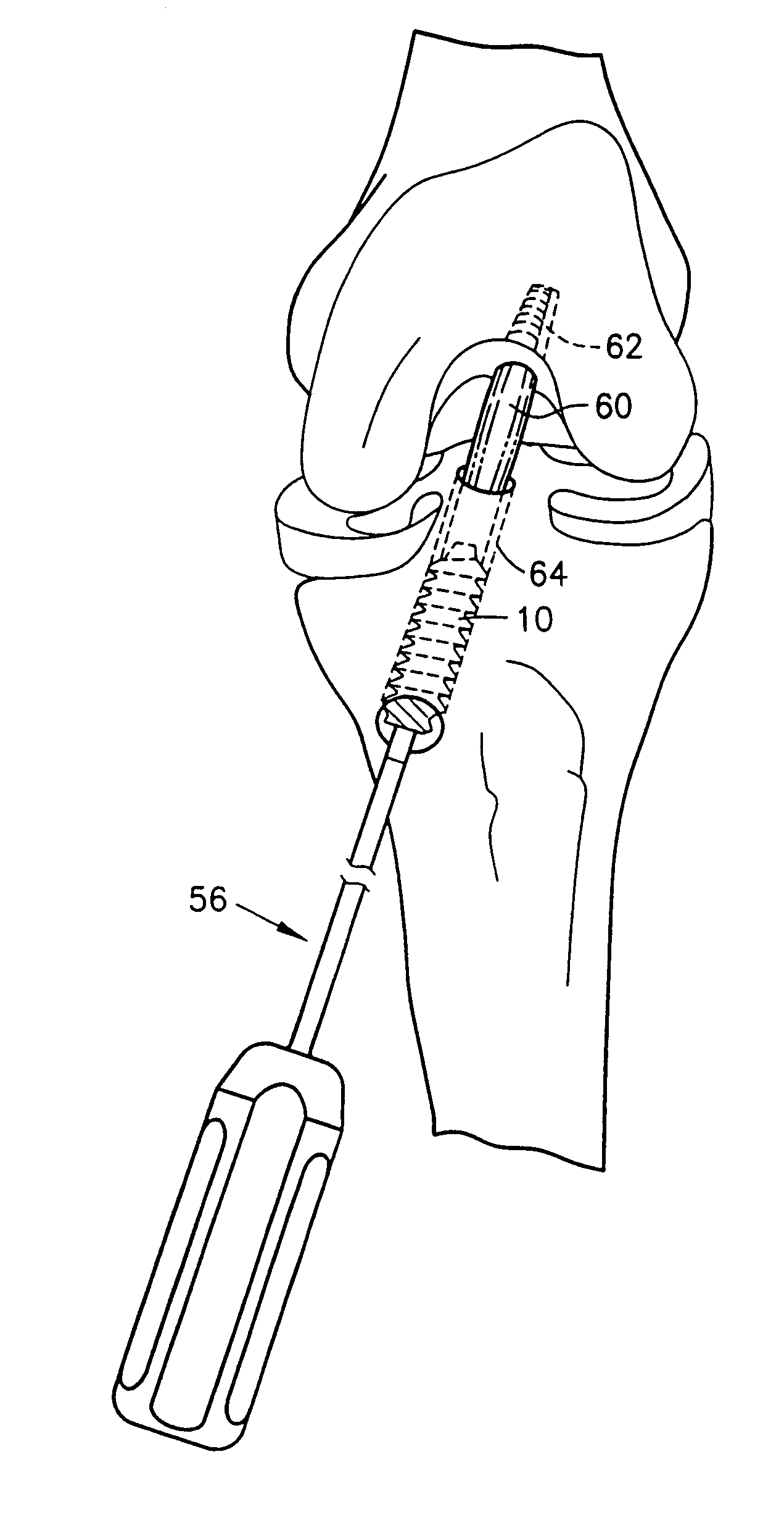 Bioabsorbable interference screw for endosteal fixation of ligaments