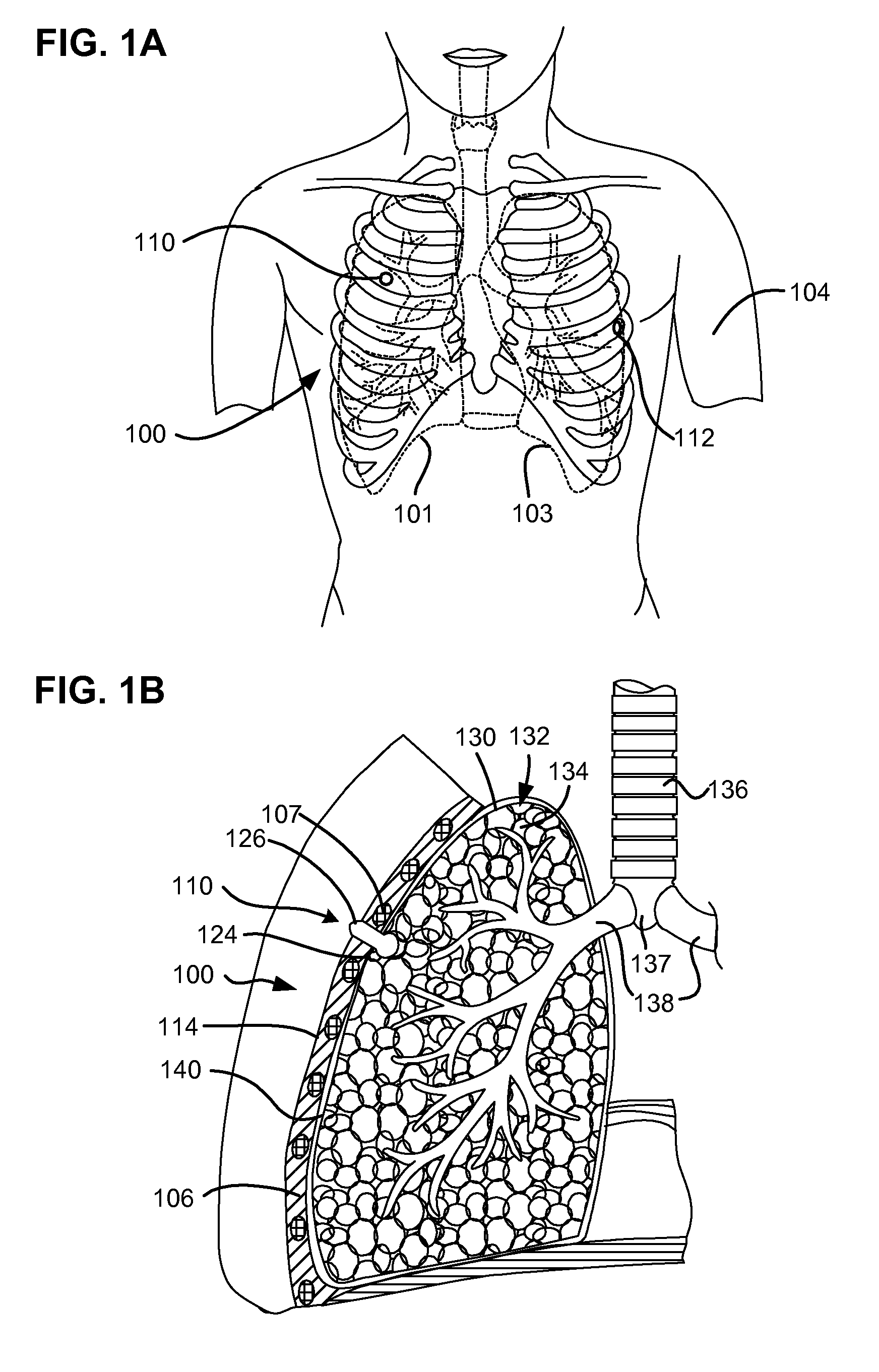 Self-sealing device and method for delivery of a therapeutic agent through a pneumostoma