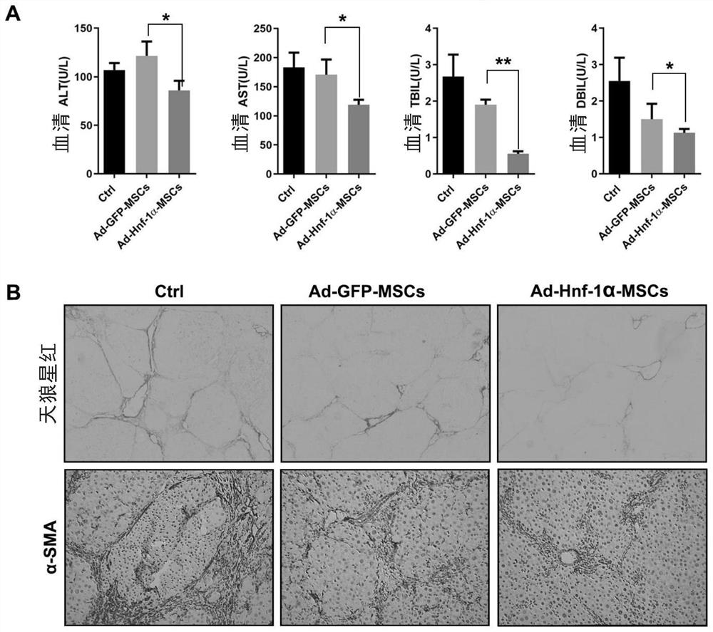 Application of Hnf-1alpha gene modified mesenchymal stem cells in prevention and treatment of liver cancer
