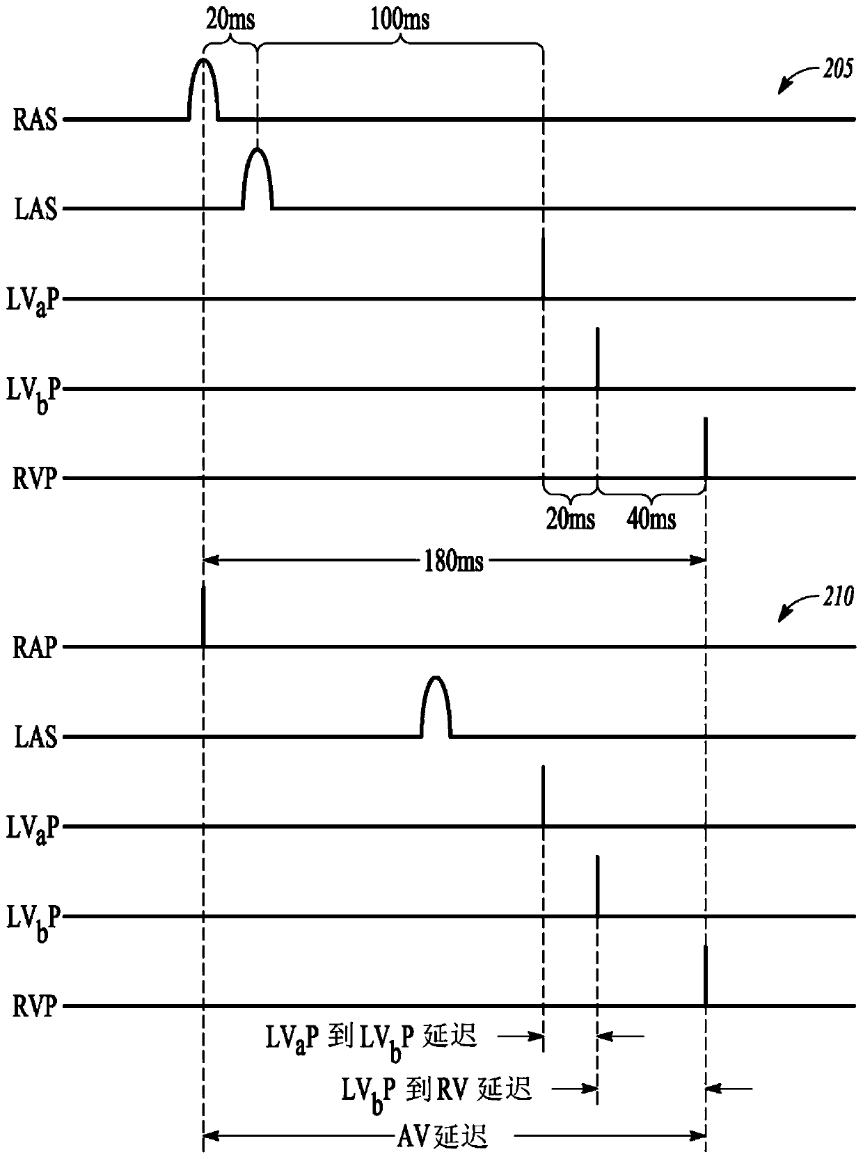 Conduction pathway driven multi-site pacing apparatus
