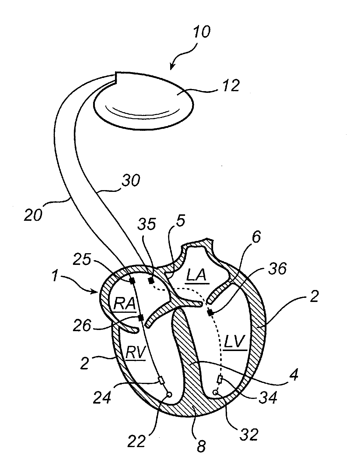 Implantable medical device and method for monitoring valve movements of a heart