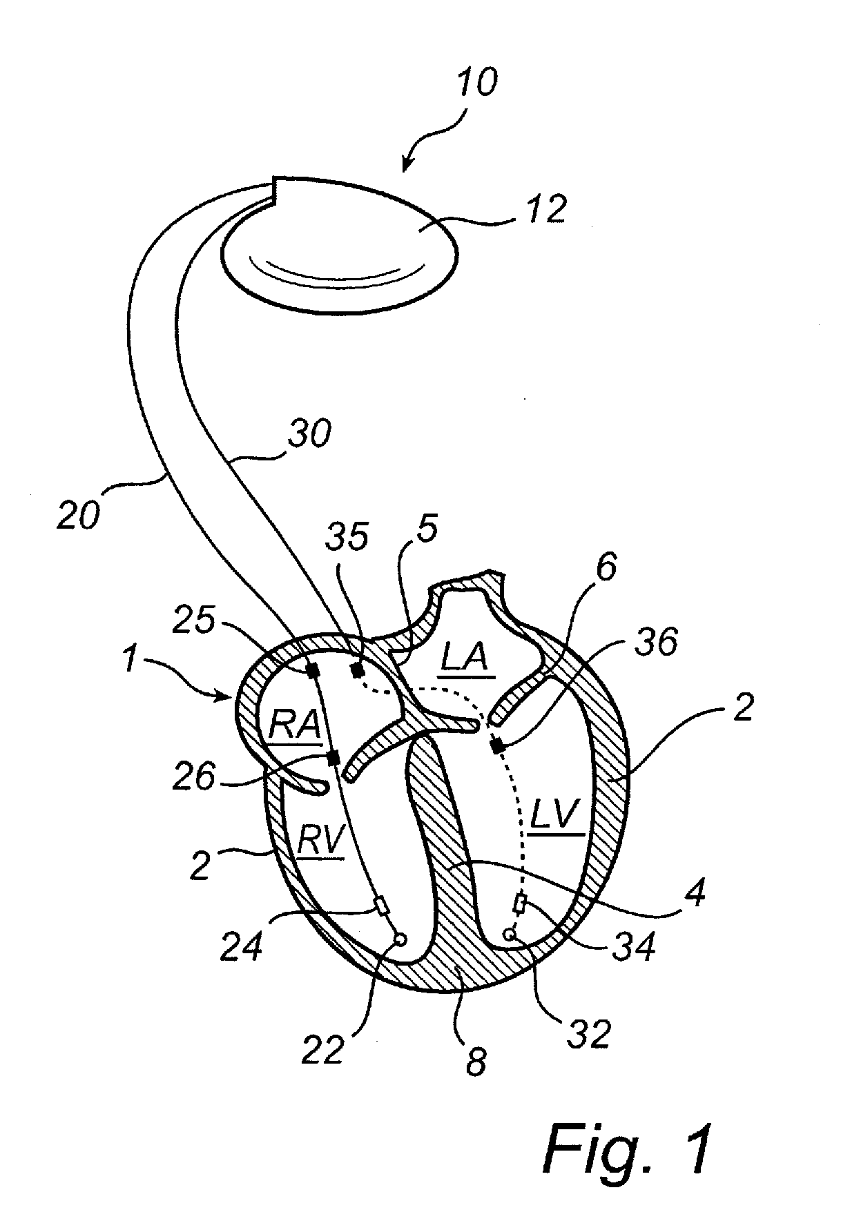 Implantable medical device and method for monitoring valve movements of a heart