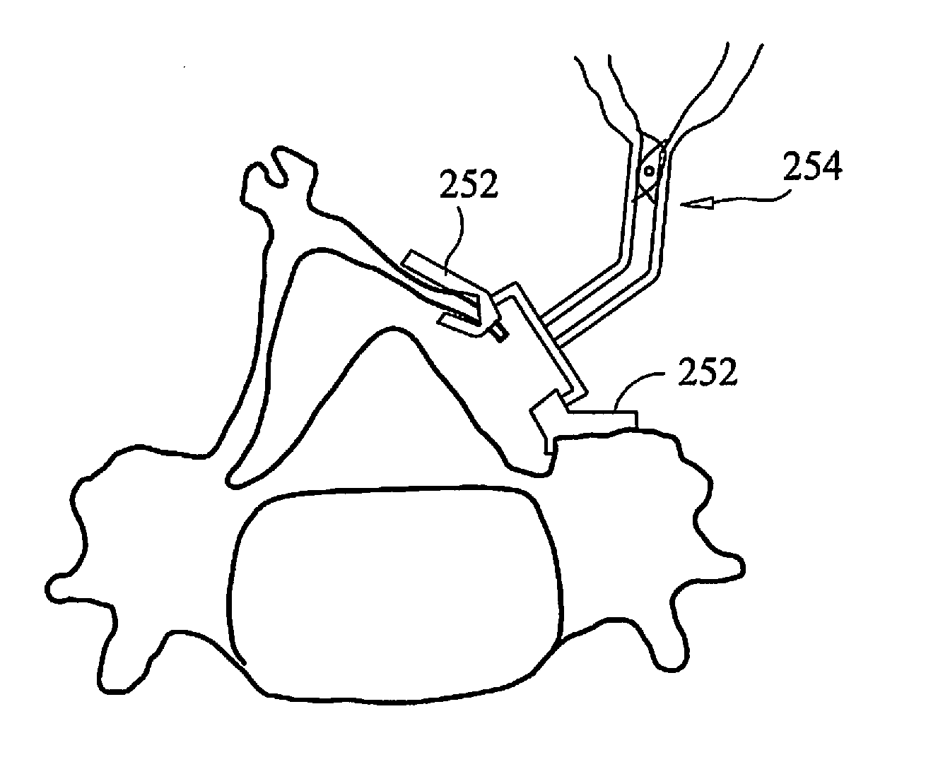 Laminoplasty fixation devices