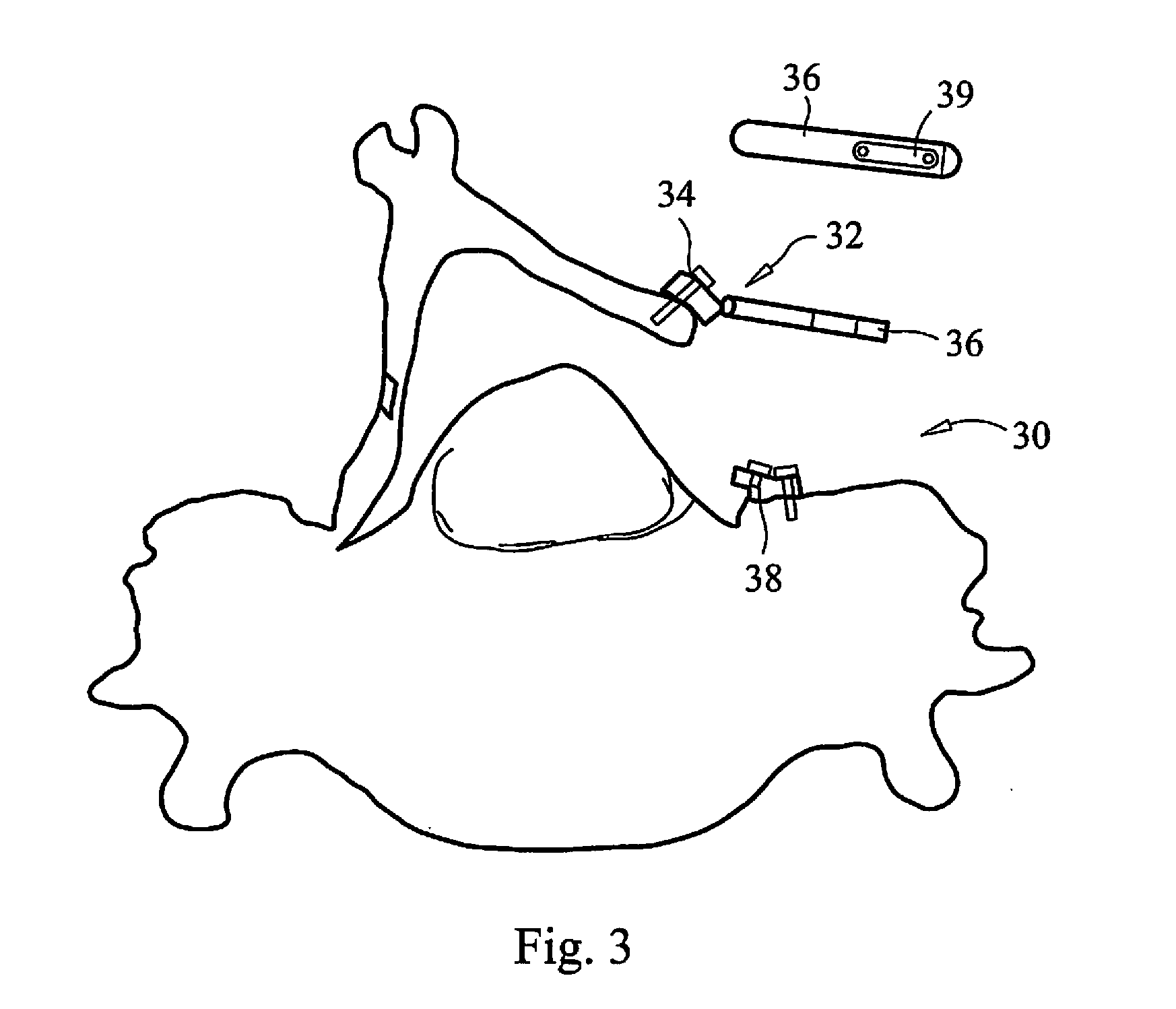 Laminoplasty fixation devices