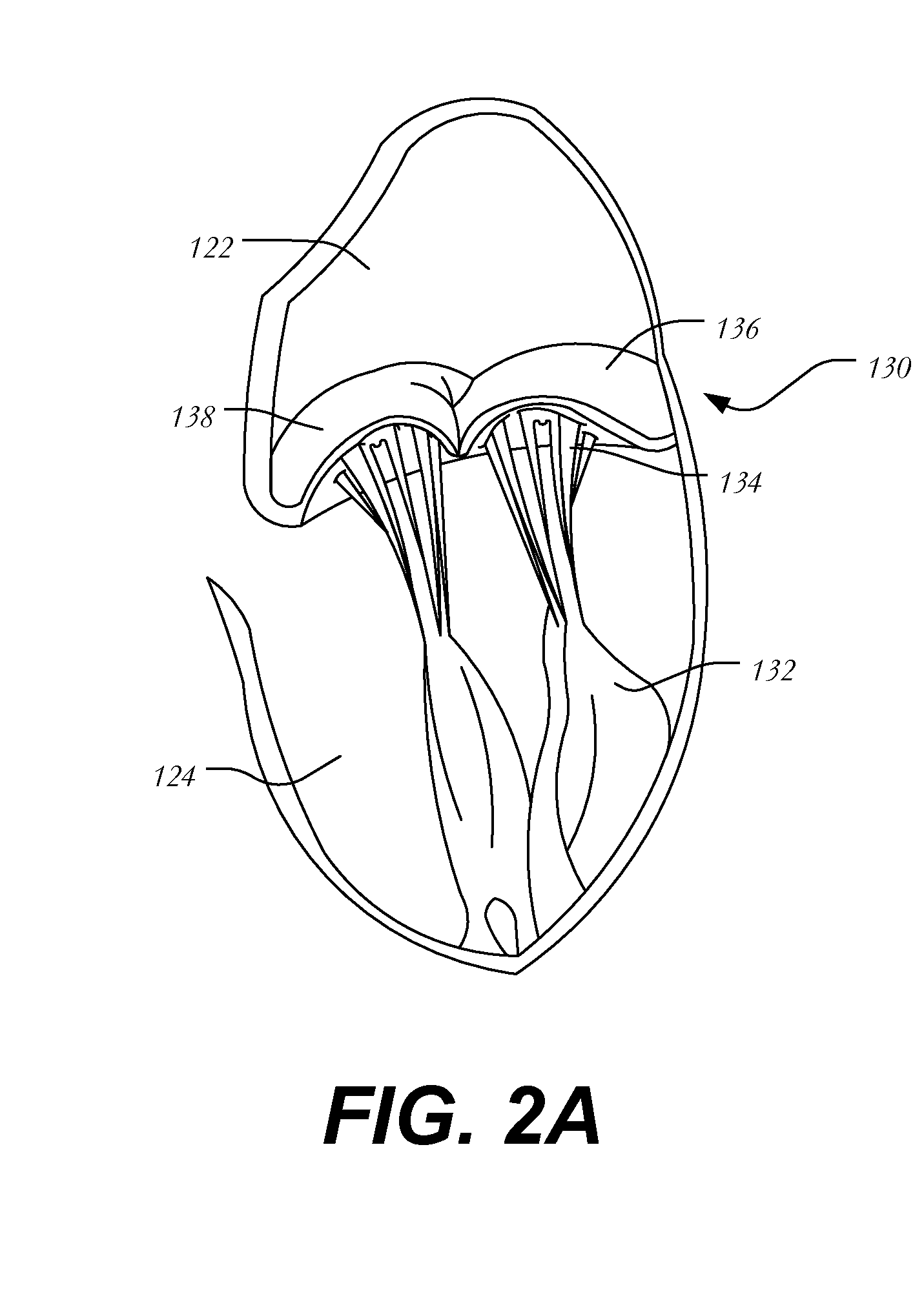 Transapical mitral chordae replacement