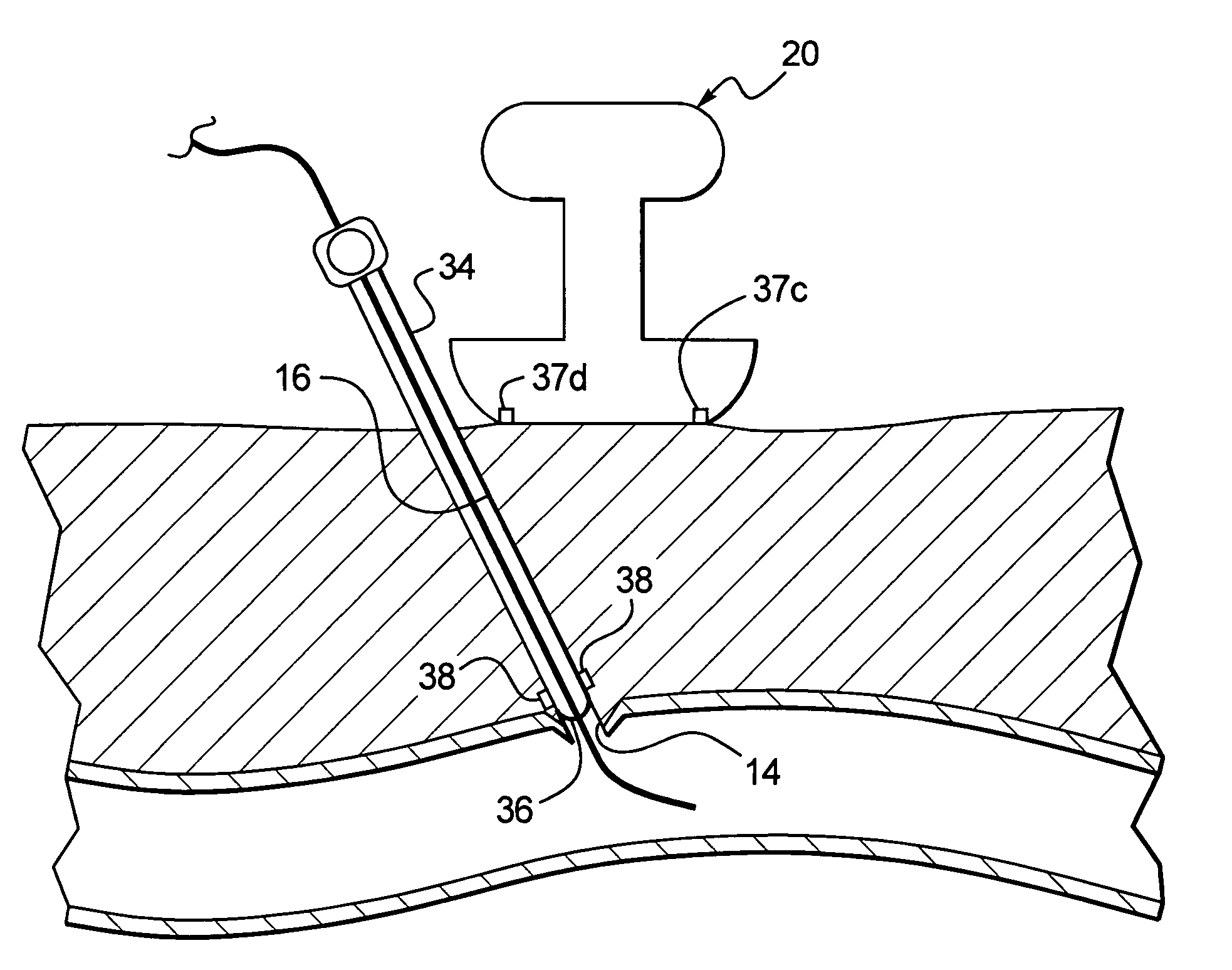 Device and method for determining the location of a vascular opening prior to application of HIFU energy to seal the opening
