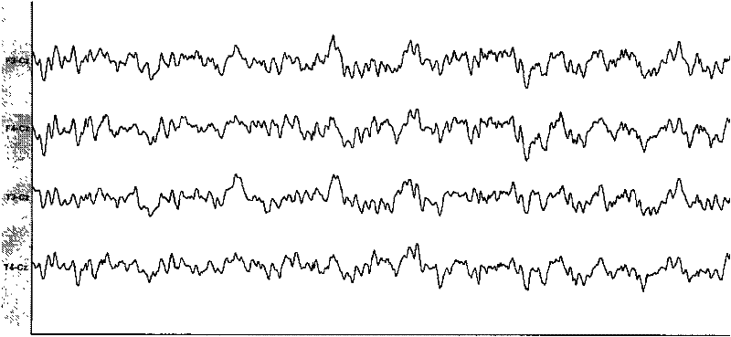 Rhesus monkey temporal lobe epilepsy kindling model and drug screening method thereof