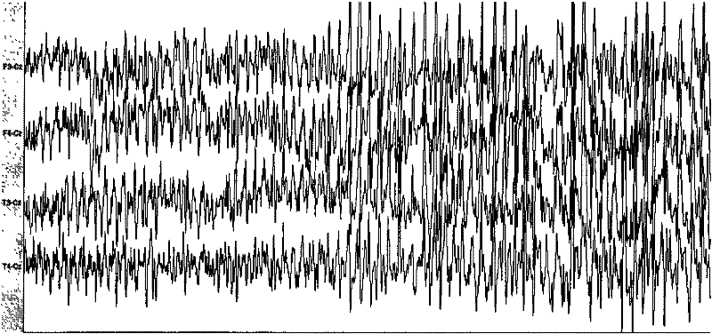 Rhesus monkey temporal lobe epilepsy kindling model and drug screening method thereof