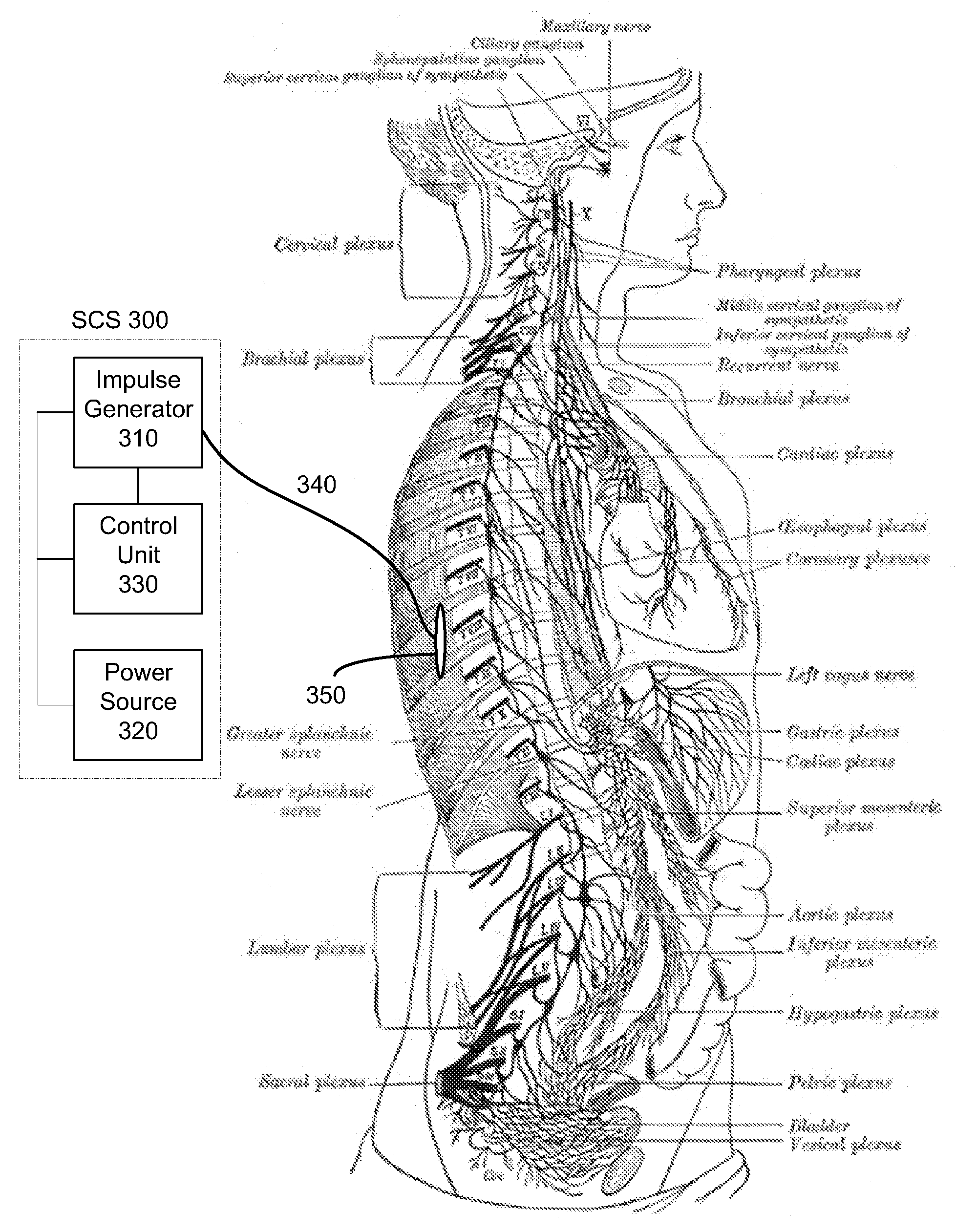 Methods And Apparatus For Treating Ileus Condition Using Electrical Signals