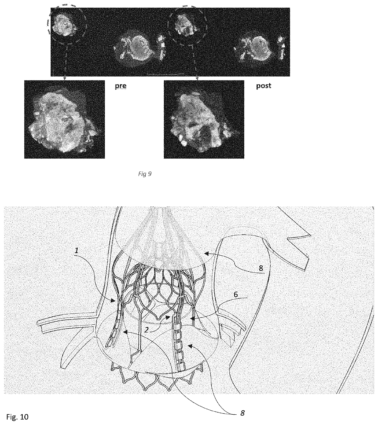 Device for the Treatment of Tissue Calcification
