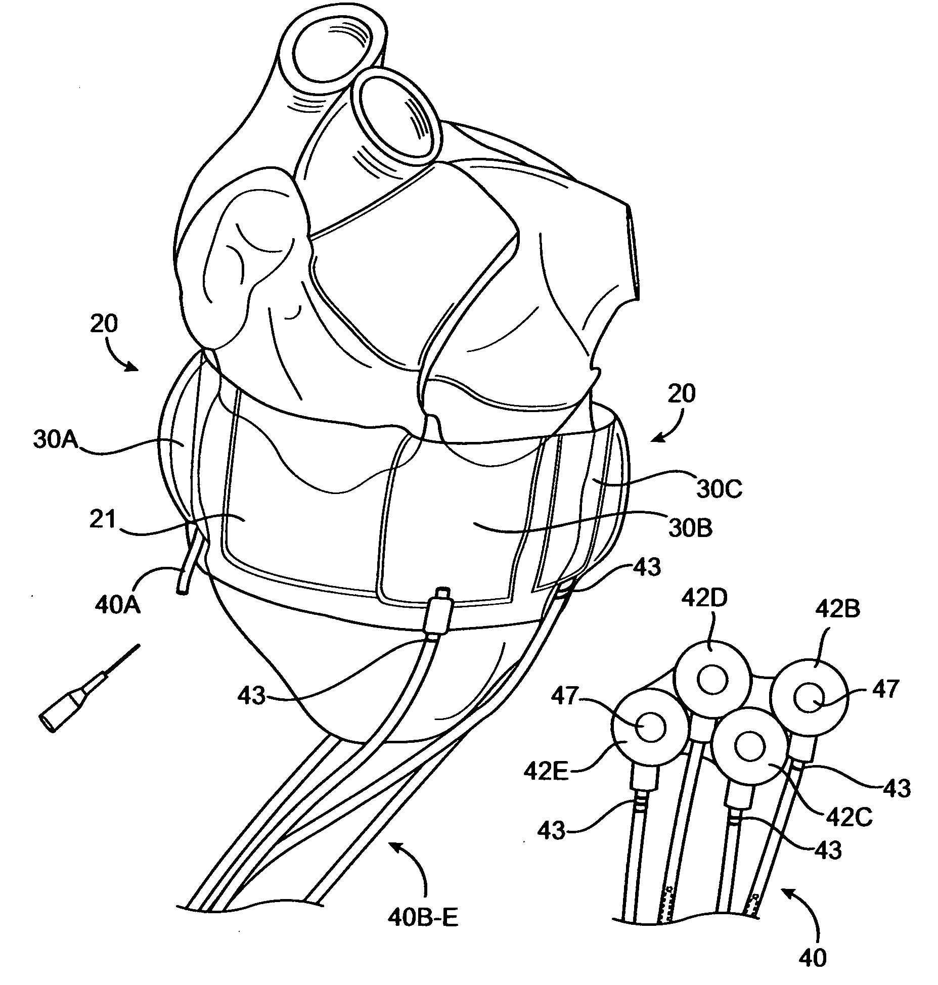 Heart band with fillable chambers to modify heart valve function
