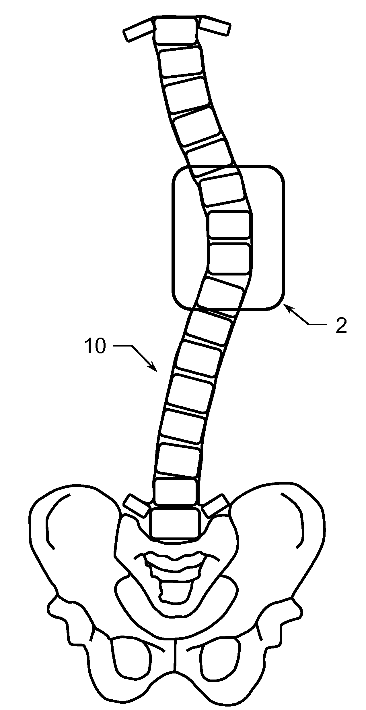 Method of Treating Scoliosis Using a Biological Implant