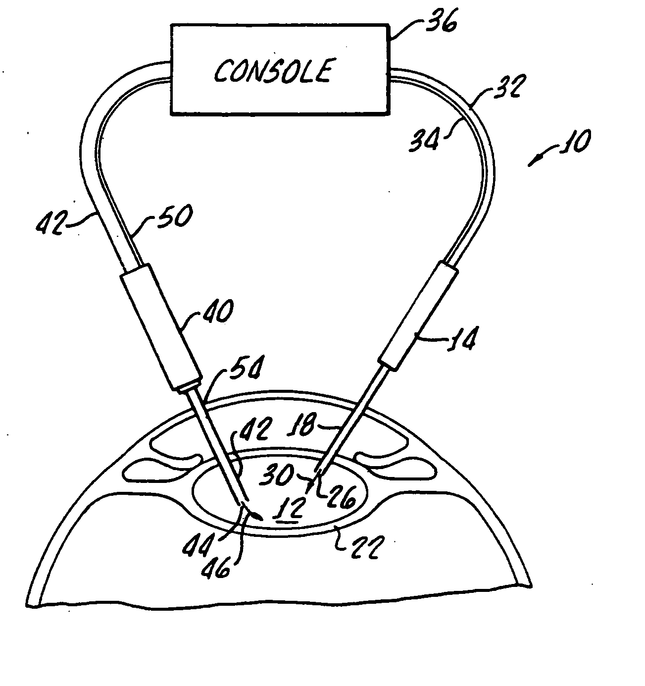 Cataract extraction apparatus and method with rapid pulse phaco power