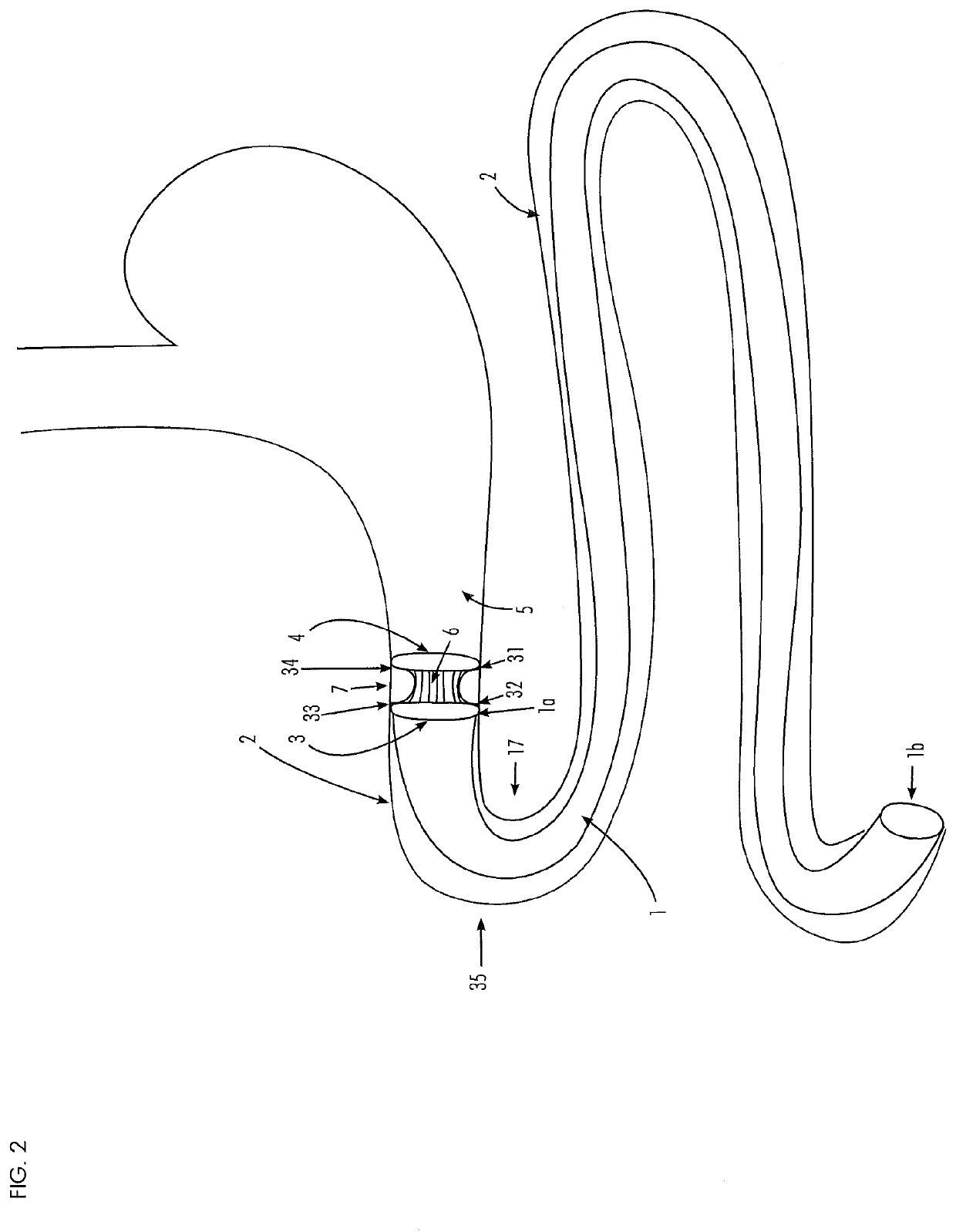 Gastrointestinal implant and positioning apparatus therefor